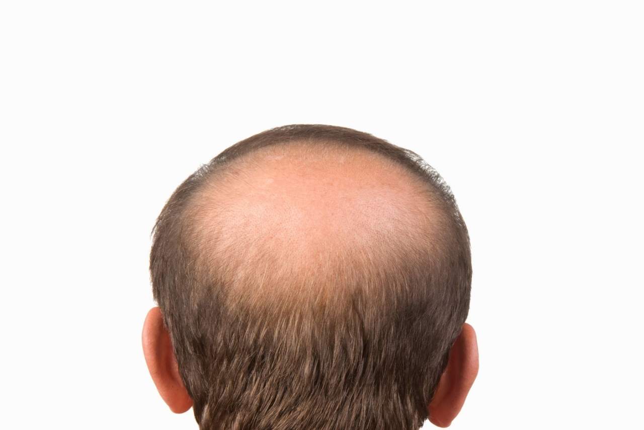 Consejos de Natura Estilo sobre cómo prevenir alopecia androgenética