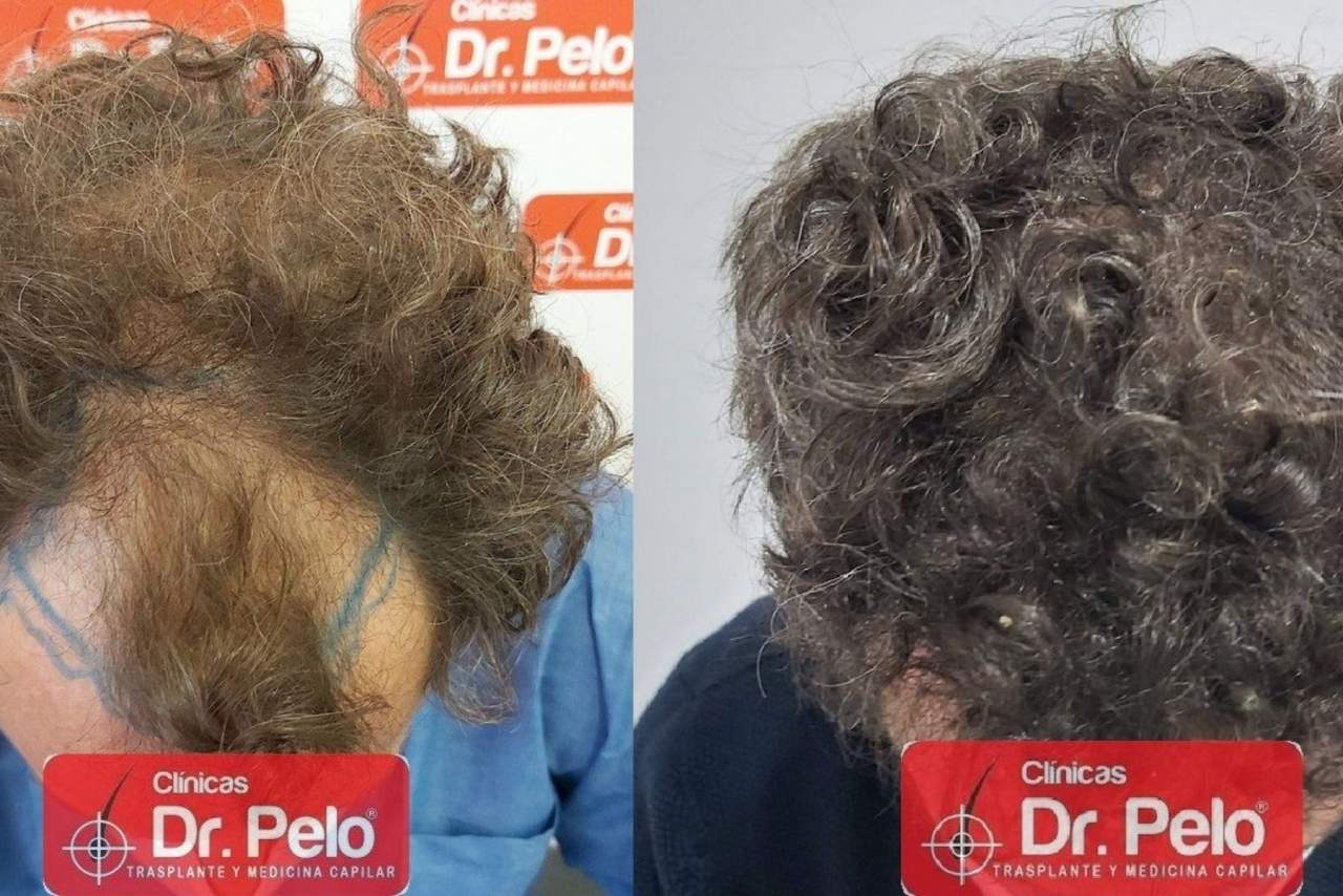 ¿Cómo es el injerto capilar en Sevilla en la Clínica Dr. Pelo?