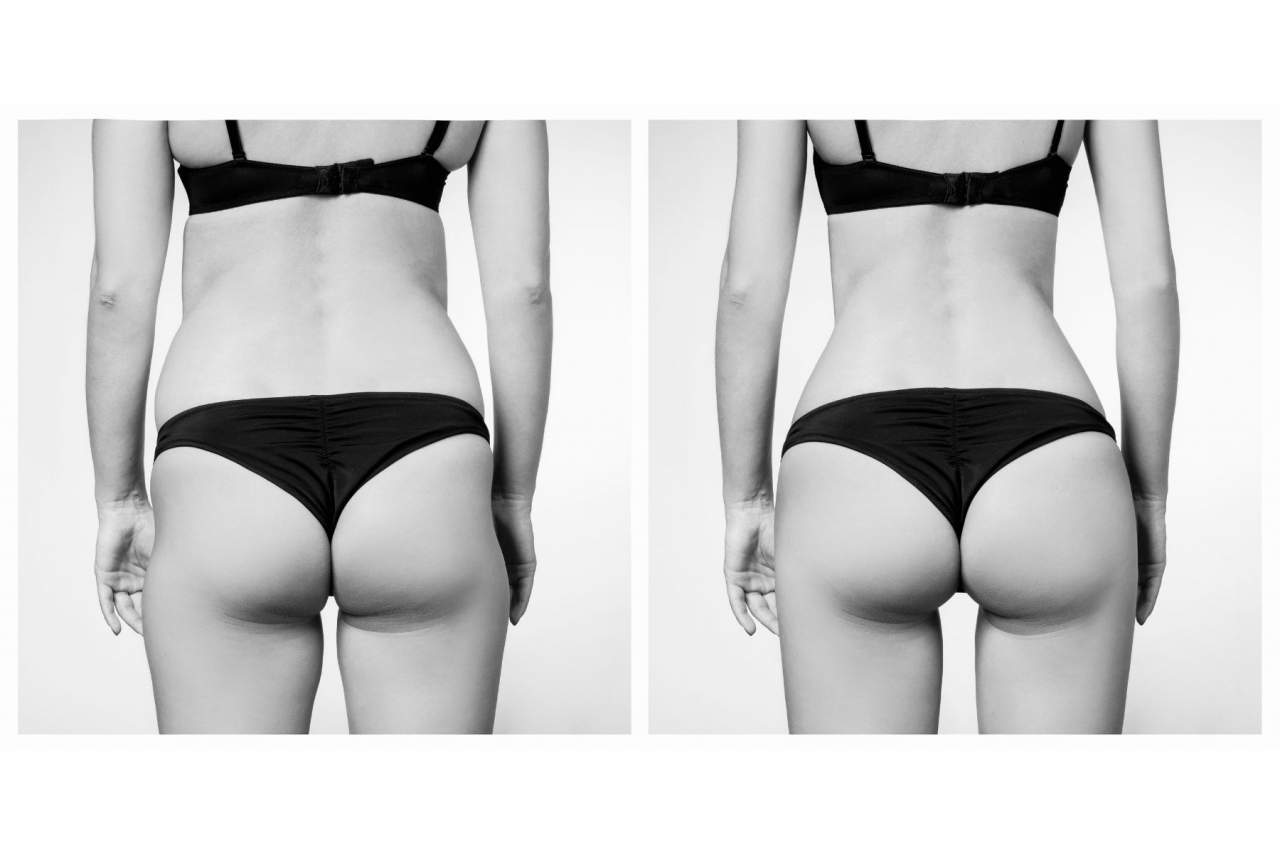 El tratamiento que permite eliminar grasa localizada en Barcelona por la Clínica Ciscar: Hidrolipoclasia 4D
