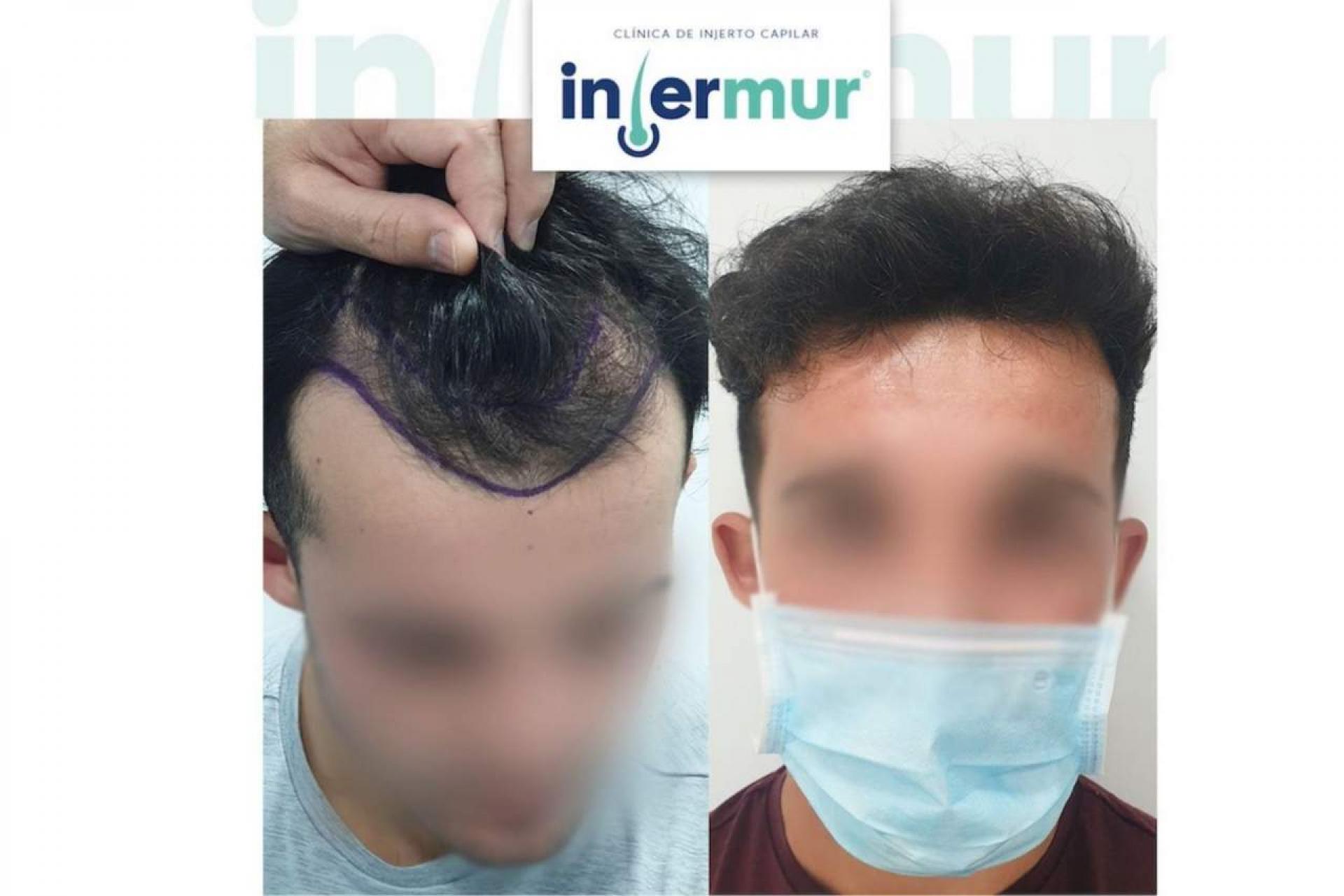 Injermur: ¿Cómo han evolucionado las técnicas de injerto capilar en España?