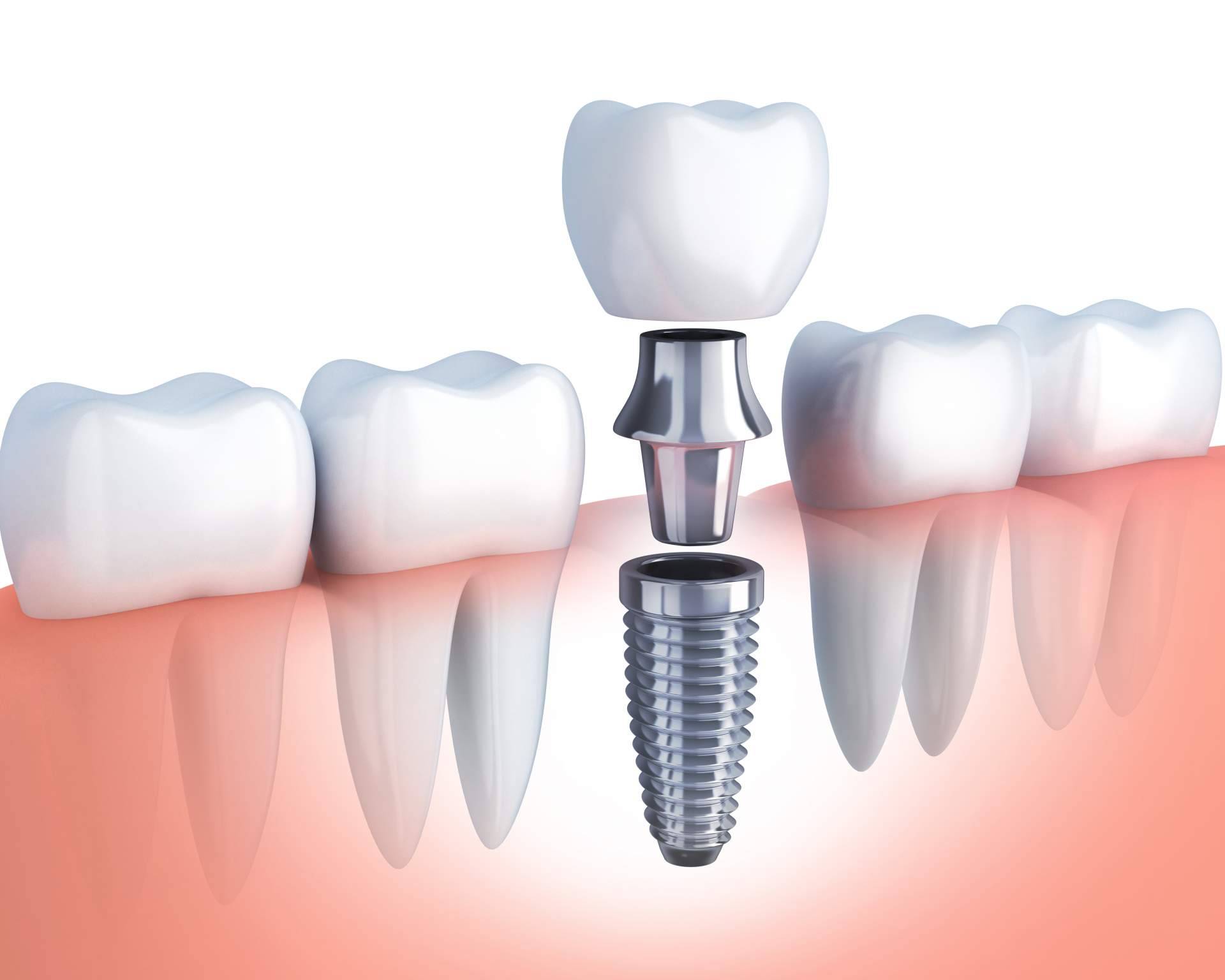 La Clínica Artydents en Madrid, reconocida por la calidad de su implante dental de titanio V