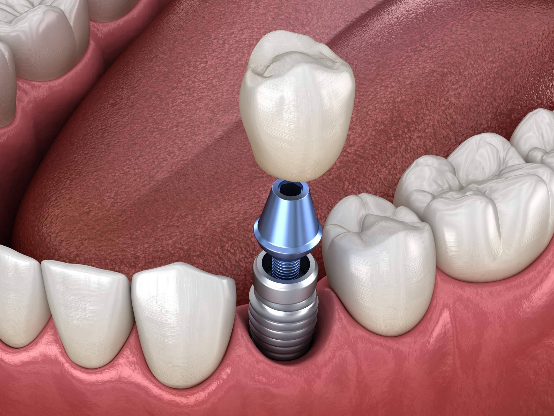 Los dientes fijos en un día son una realidad tras el trabajo de la Clínica dental especializada Artydents en Madrid