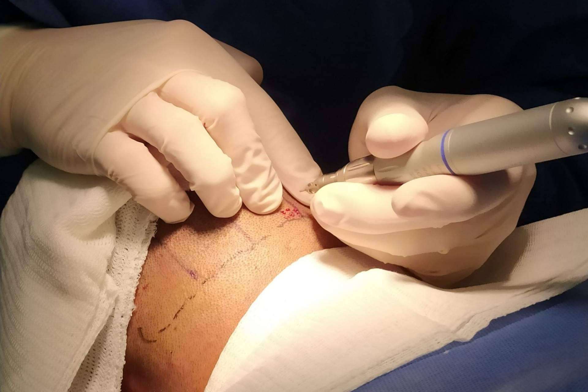 Microinjerto capilar en la clínica estética de Alcobendas de Clínica Tarrazo