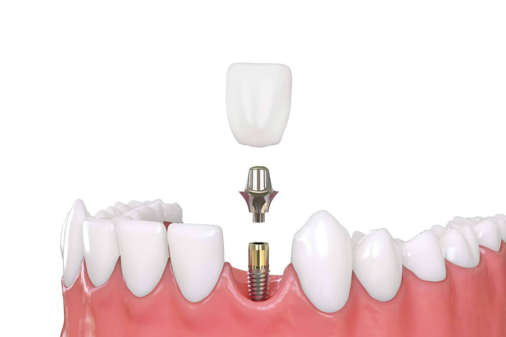 Los implantes de carga inmediata que ofrece Implant Clinics