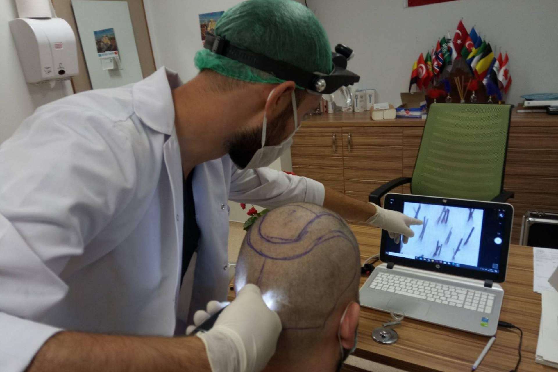 Injerto capilar Turquía todo incluido con FUE Hair Transplant System