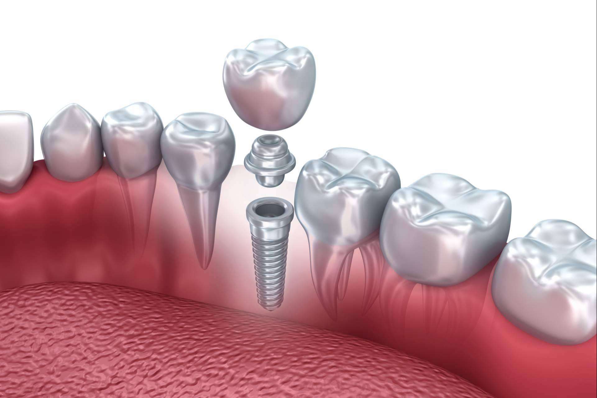 Las ventajas de realizarse un implante dental en Valladolid por la Clínica Dental Heins