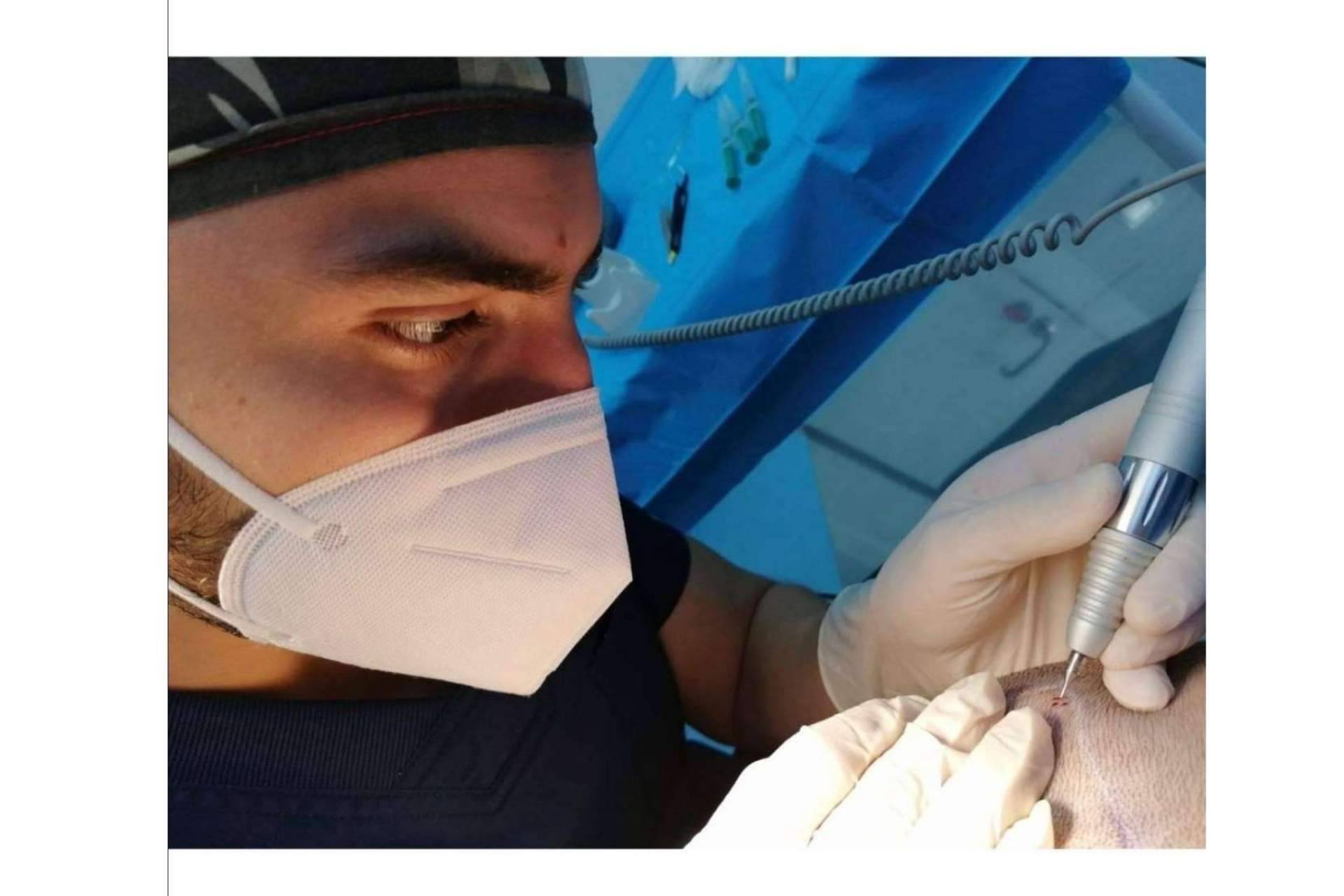 La fase del desierto capilar: ¿En qué momento se empieza a caer el pelo implantado?, según Doctor Bern