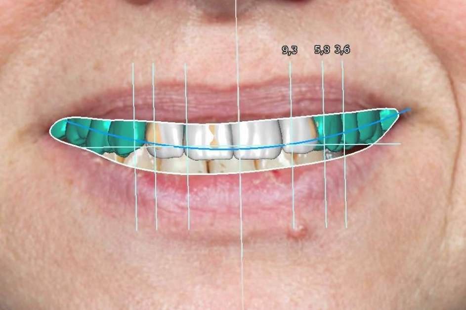 Clínica Blay+Monzó, grandes especialistas en el diseño de sonrisas