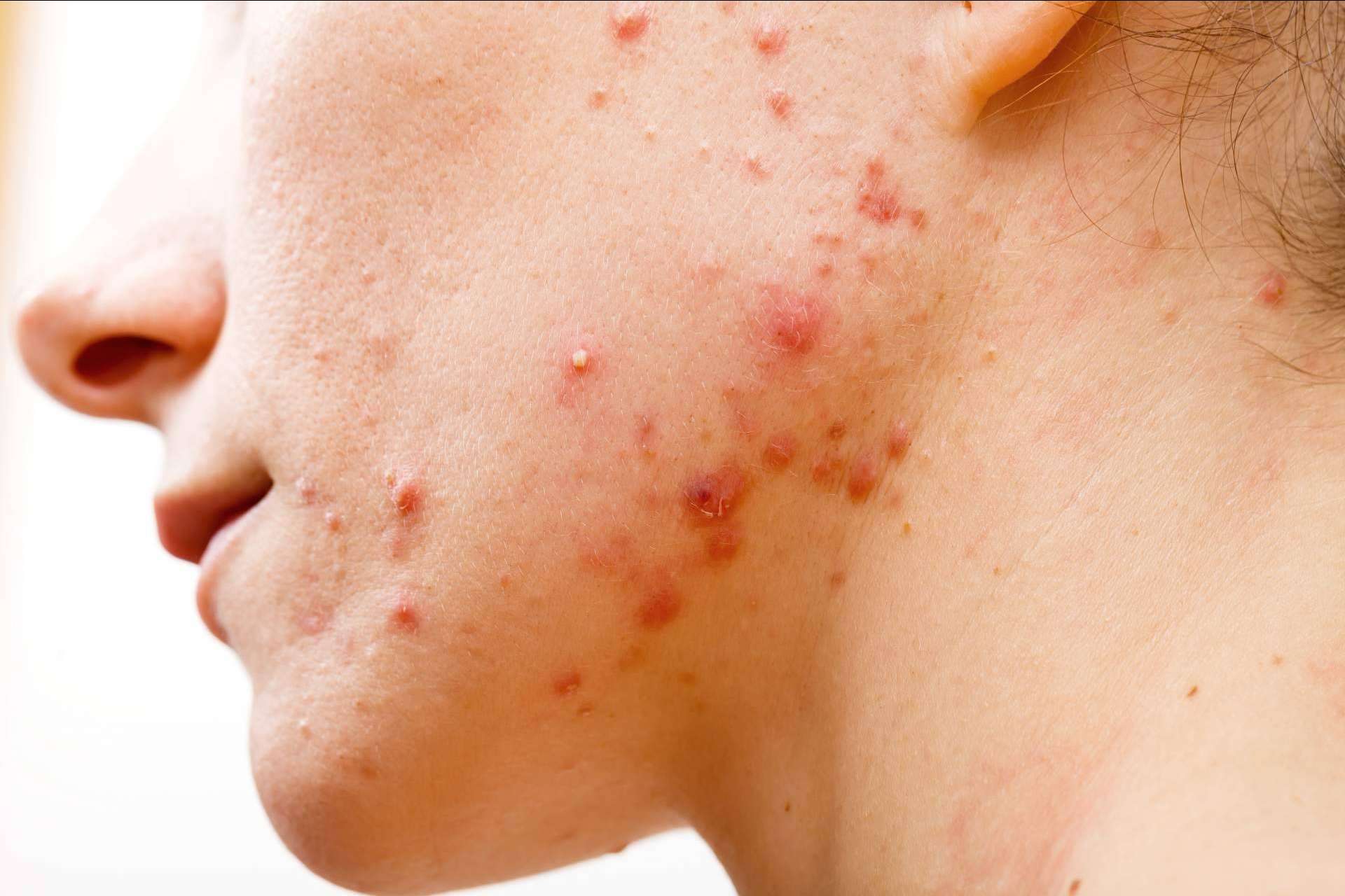 AcnéXero, la aplicación fundada por dermatólogos que propone soluciones efectivas contra el acné