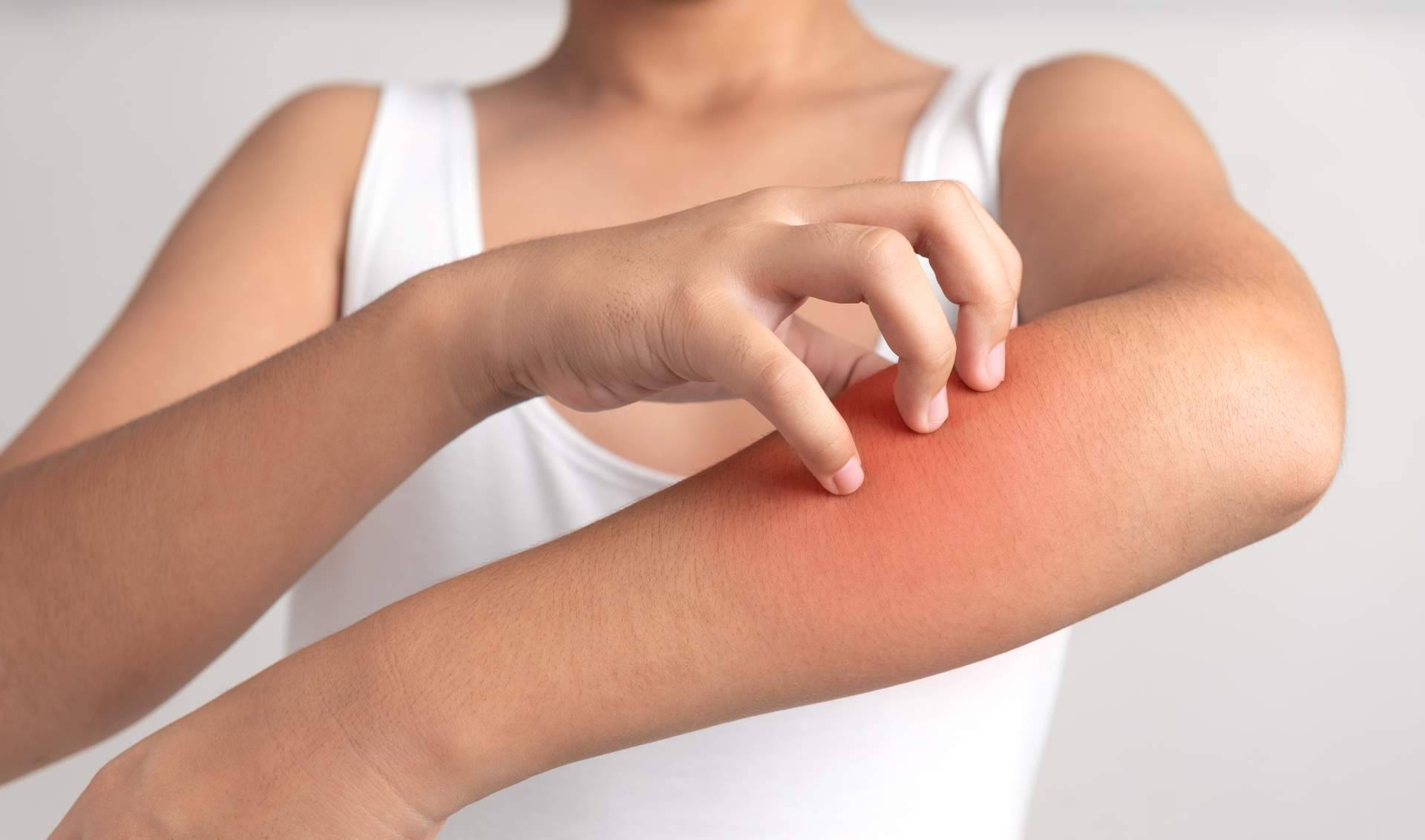 En Laboratorio Géomer, se puede encontrar un tratamiento natural psoriasis corporal sin cortisona