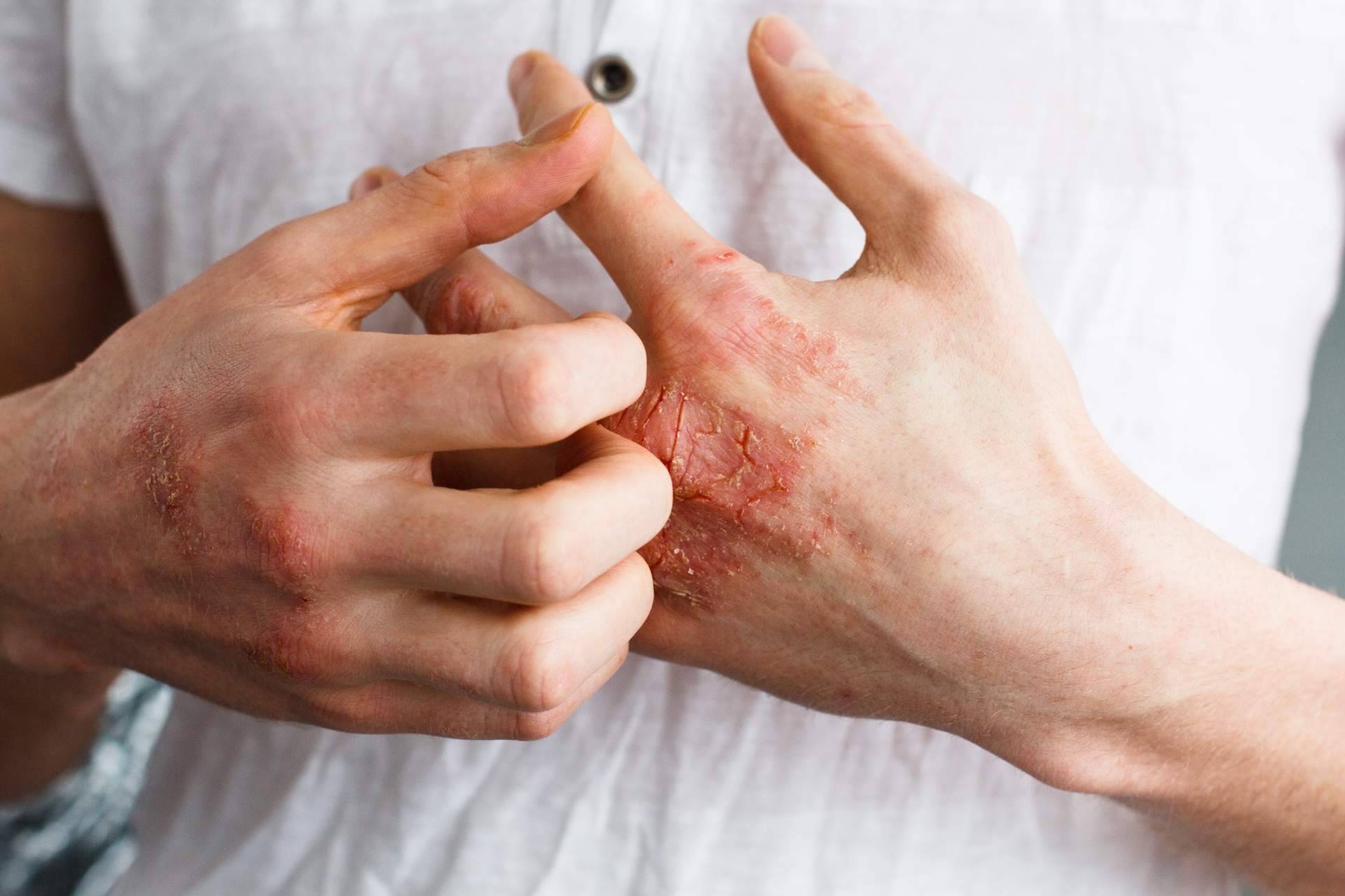 ¿Eczema de contacto o eczema atópico?, por Laboratorio Géomer