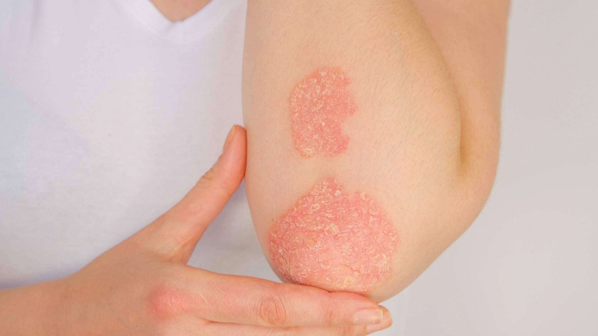 Tratamiento efectivo para la psoriasis con la línea de productos Soriasel