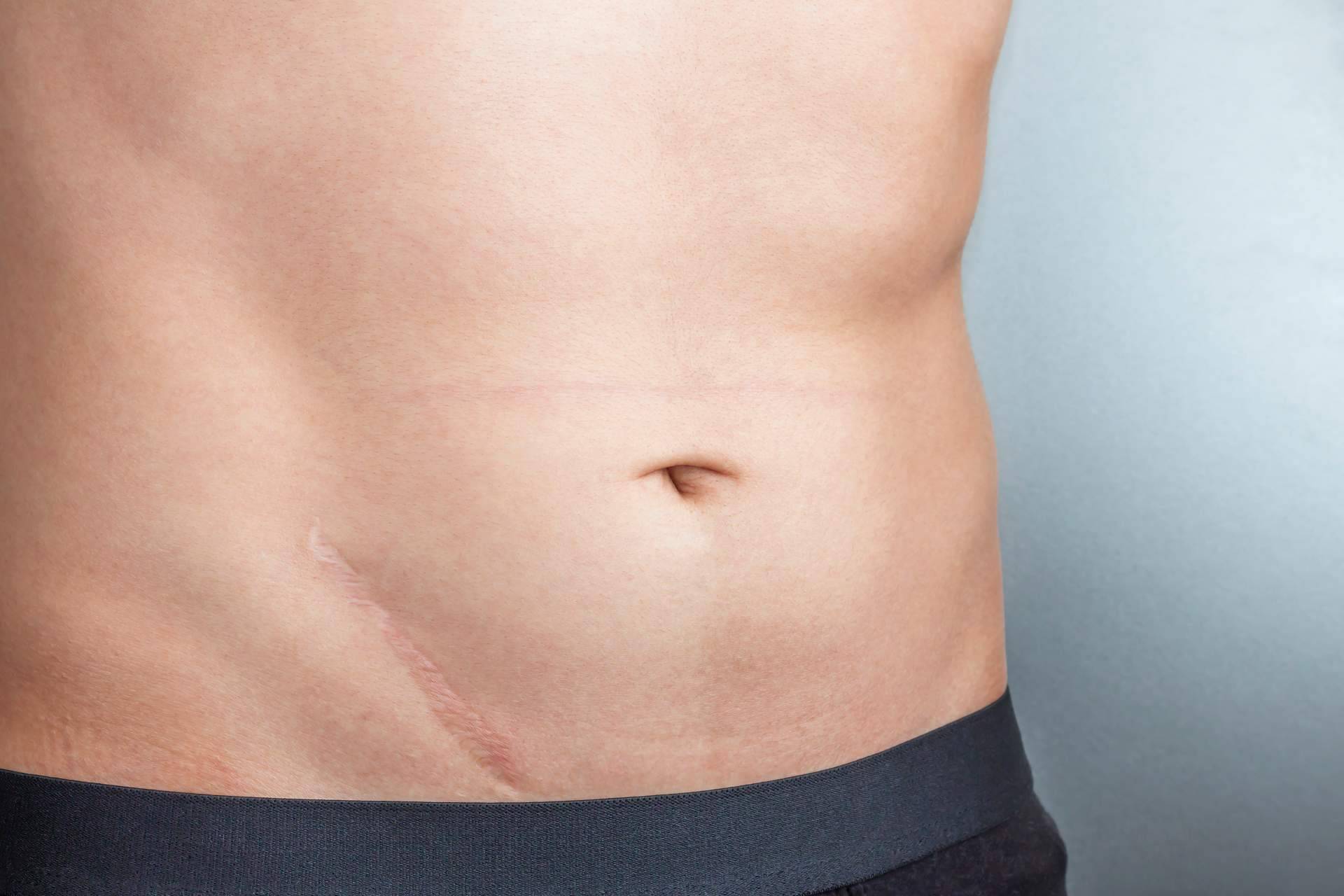 La fisioterapia y la osteopatía en el tratamiento de cicatrices y liberación de adherencias