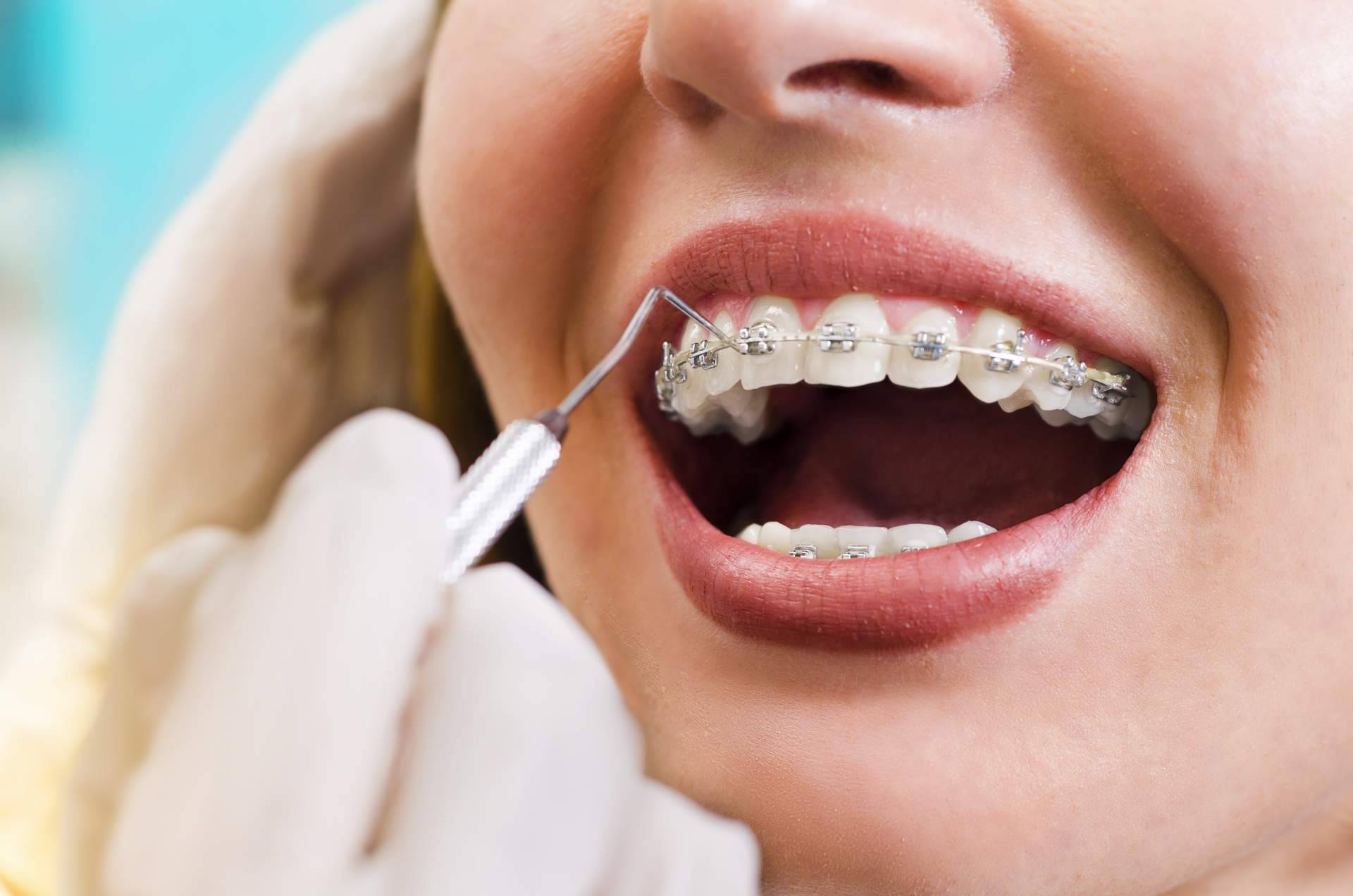 Dientes rectos, ¿estética o salud?, según Clínica Viasalud