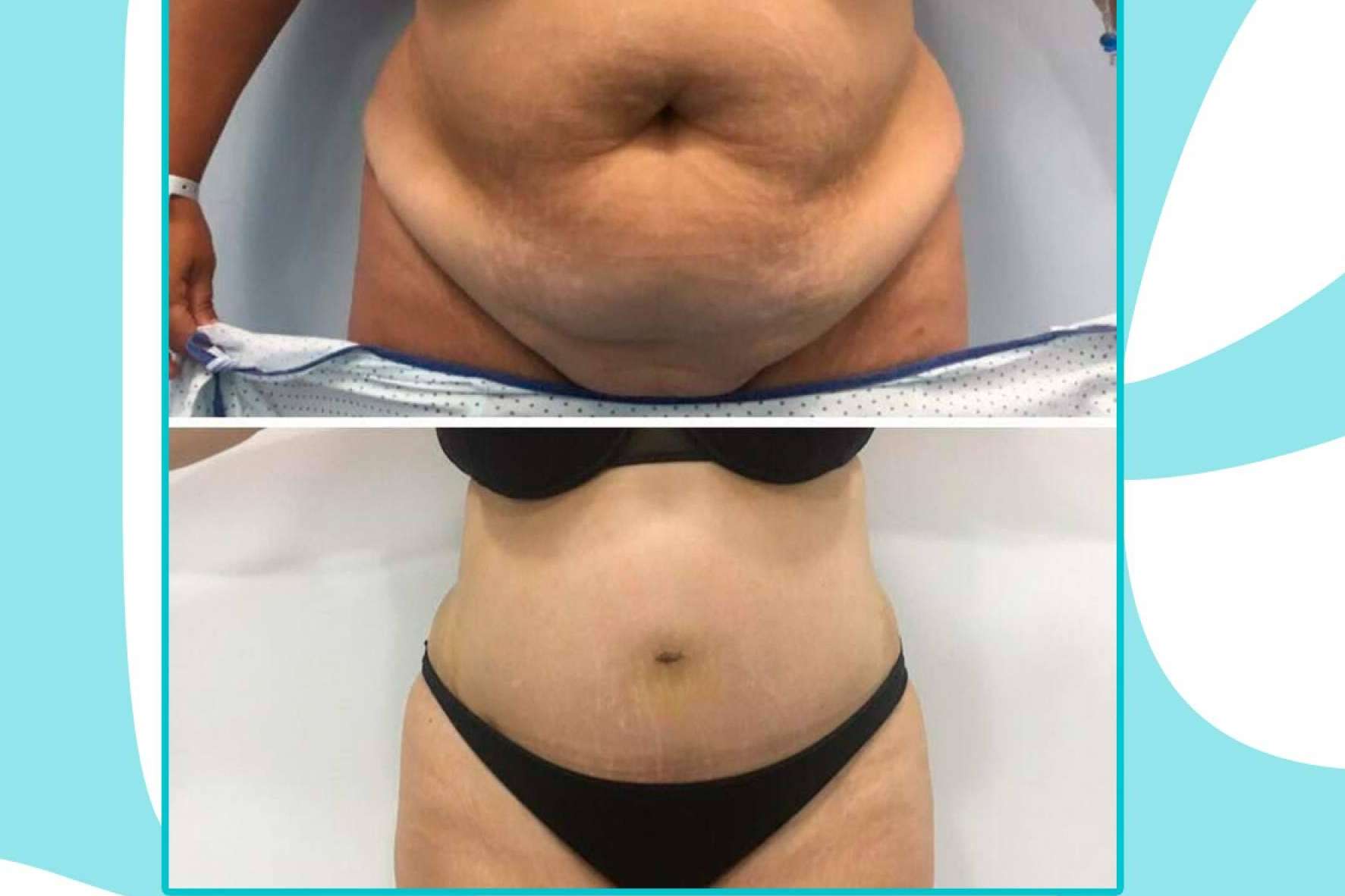 Lucir un cuerpo soñado gracias a la cirugía estética corporal de Clínicas Be