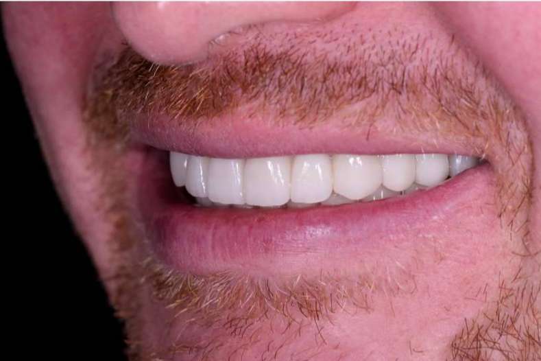 Los expertos de Clínica Viasalud afirman la posibilidad de colocar implantes en Valencia a pacientes con enfermedades periodontales