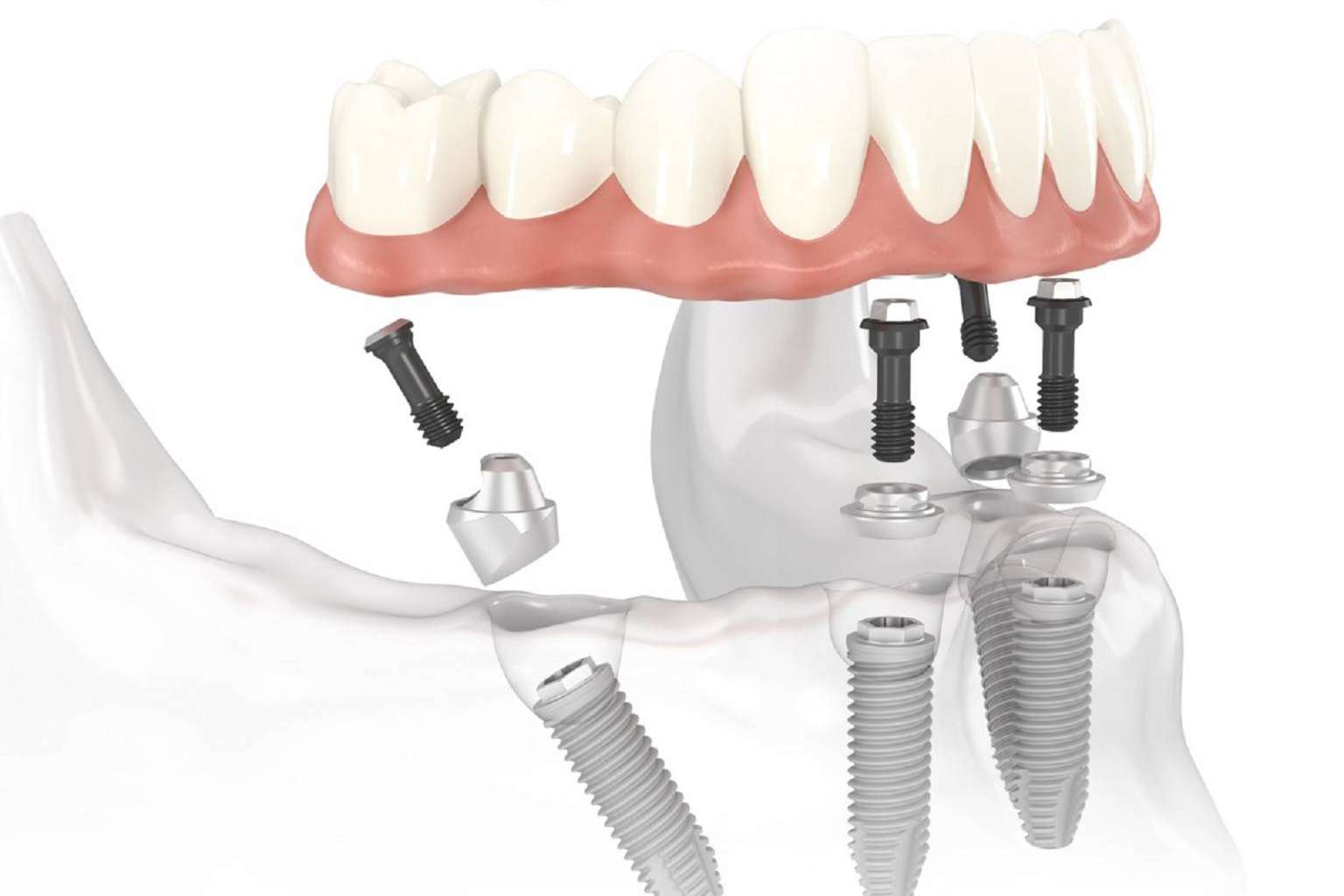 Llevar a cabo implantes dentales en un día es posible gracias a la tecnología digital de Dentinova