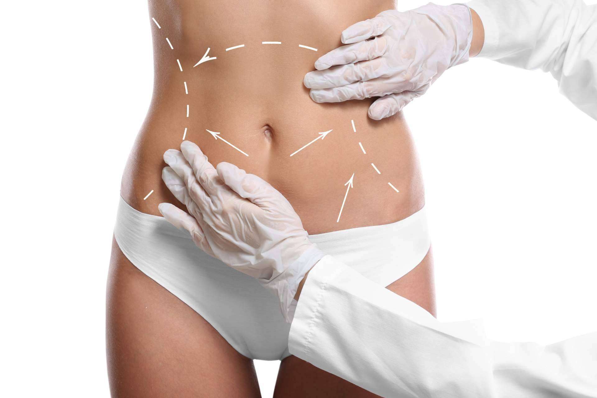 Remodelar la figura con la liposucción, de la mano de Mave Medicina Estética en Zaragoza