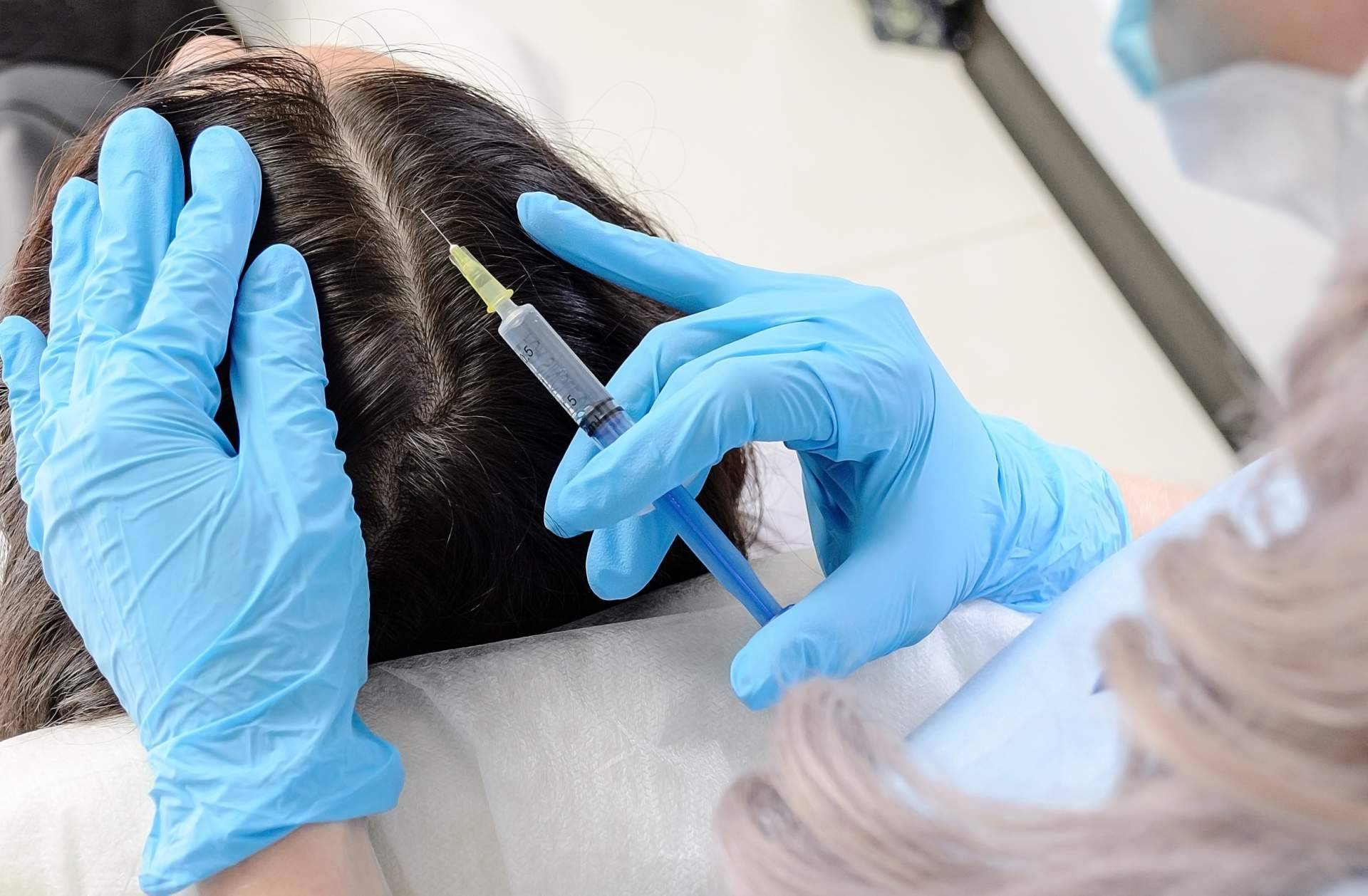 Mesoterapia capilar, vitaminas y plasma rico en plaquetas