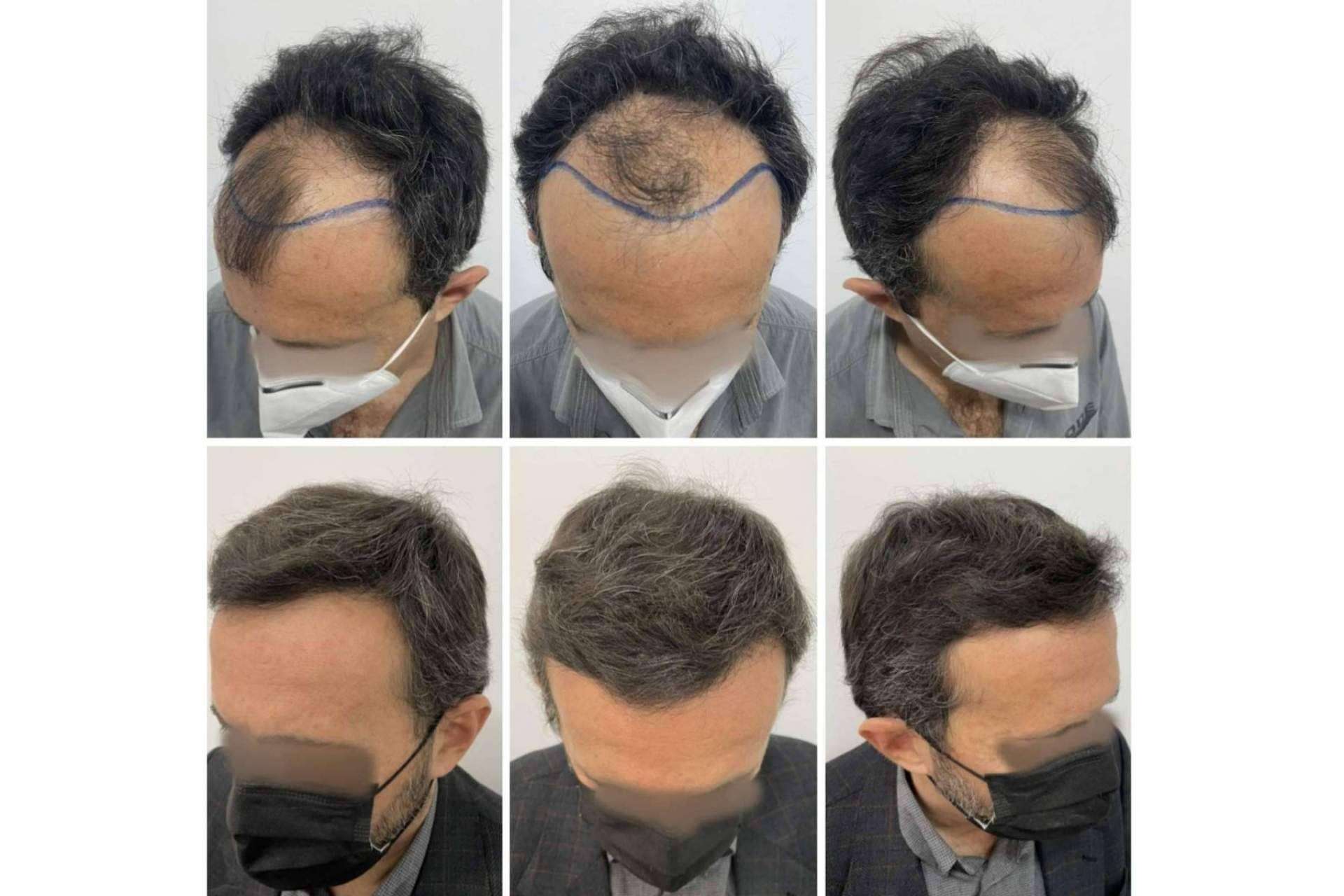 Recomendaciones de vitaminas para la caída de pelo, con el Dr. Bruno Jacobovski