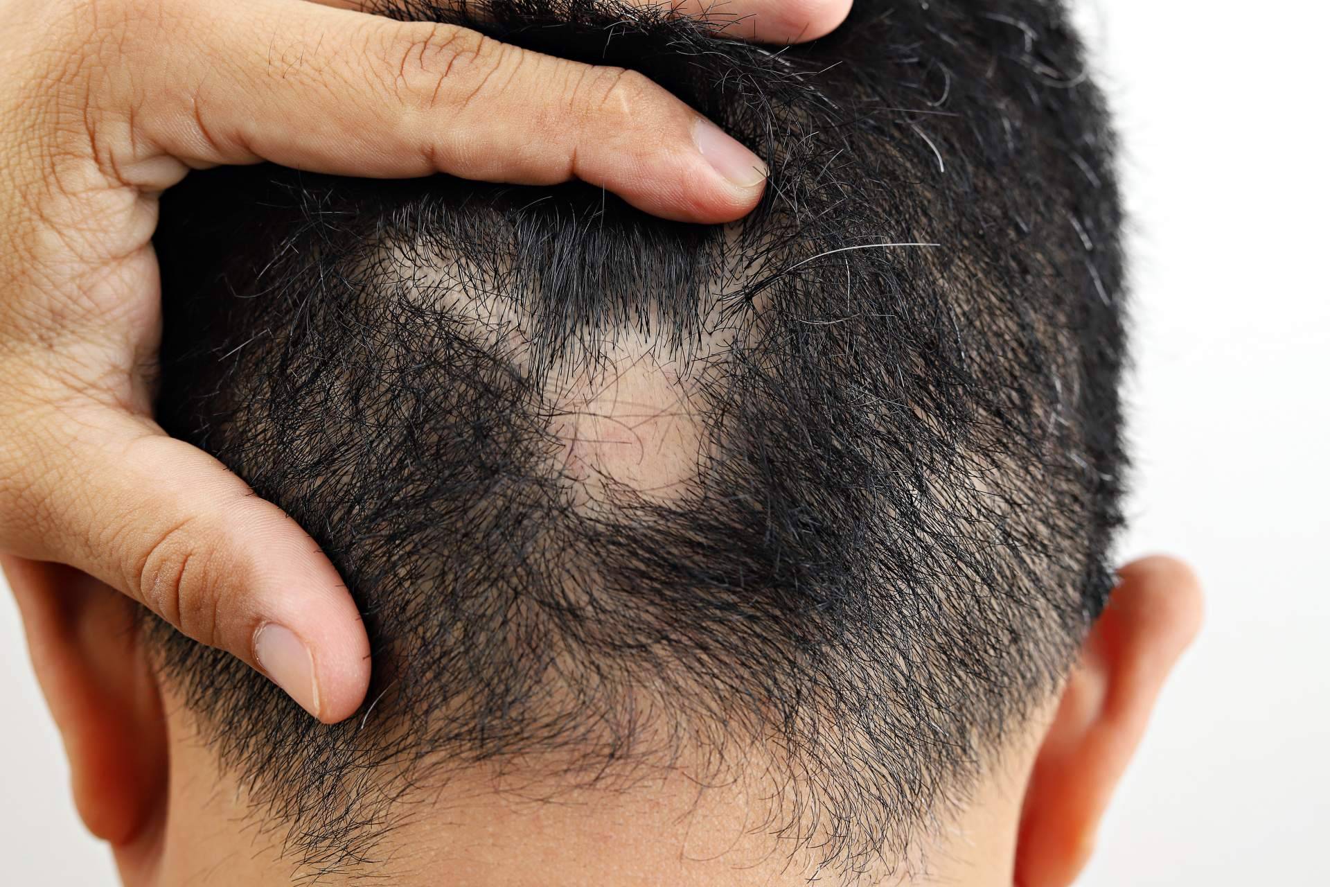 El tratamiento para alopecia areata de Saw Palmetto