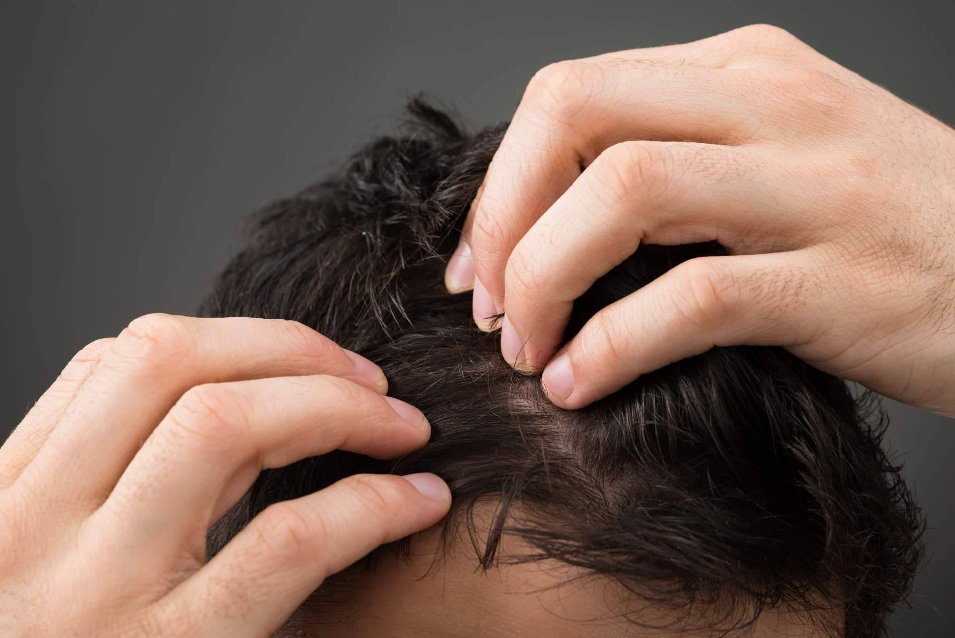 ¿En qué consiste el tratamiento de micropigmentación capilar?, por Élite Capilar