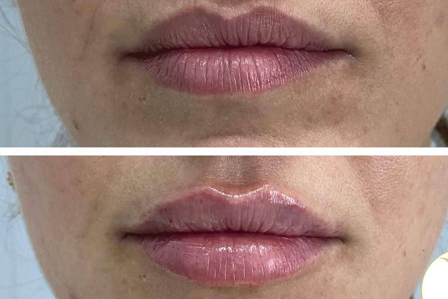 La técnica de la Clínica Yasmin para el aumento de labios con ácido hialurónico, Adiblips
