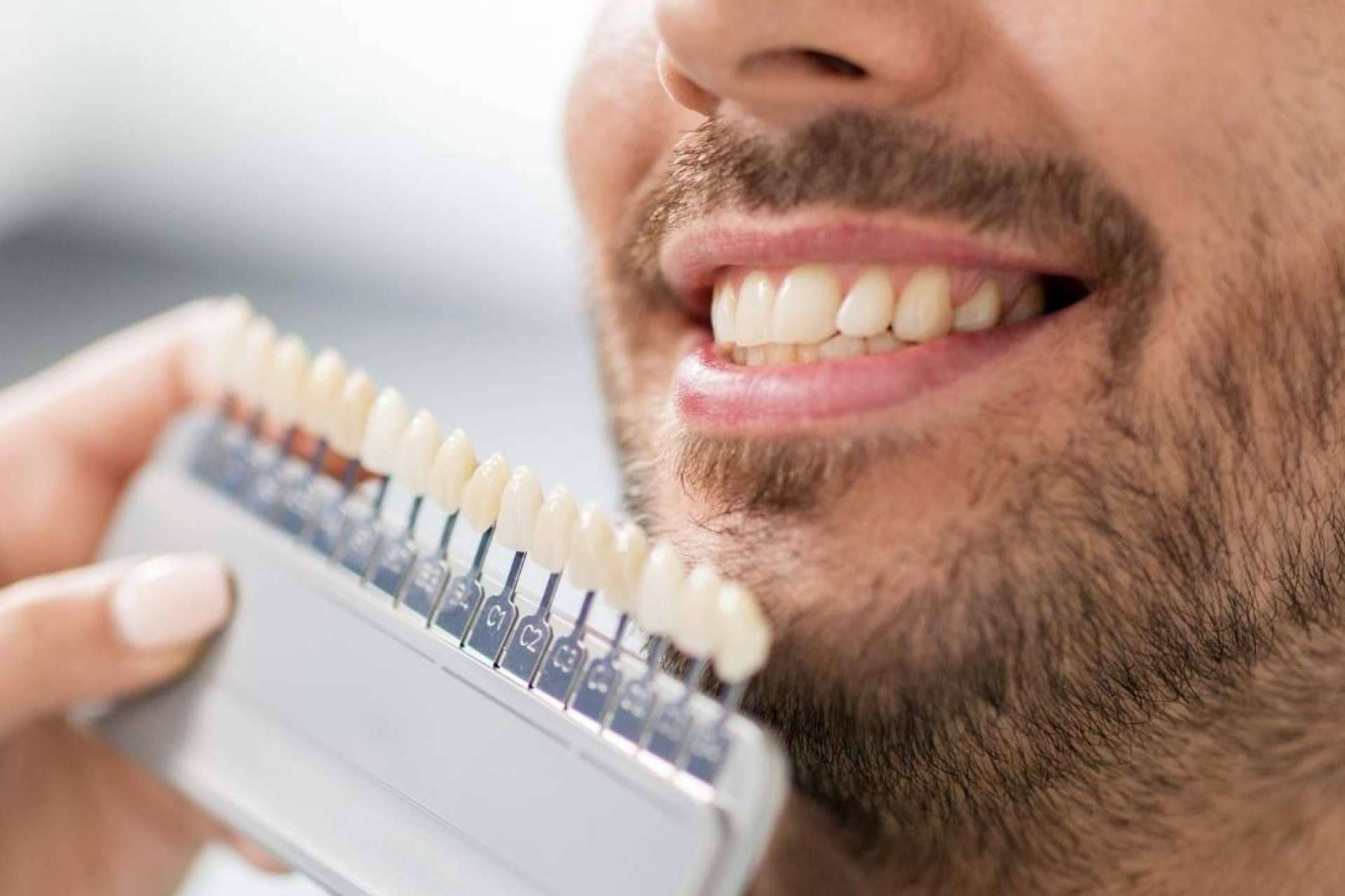 Todo acerca de las carillas dentales, por Crespí & Gandía