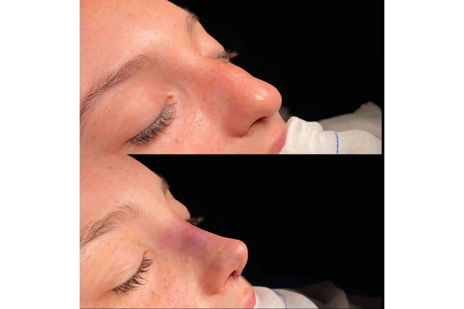 Los aspectos más importantes a la hora de elegir entre los diferentes tipos de rinoplastia, por el Dr. Álvaro Pérez-Villar