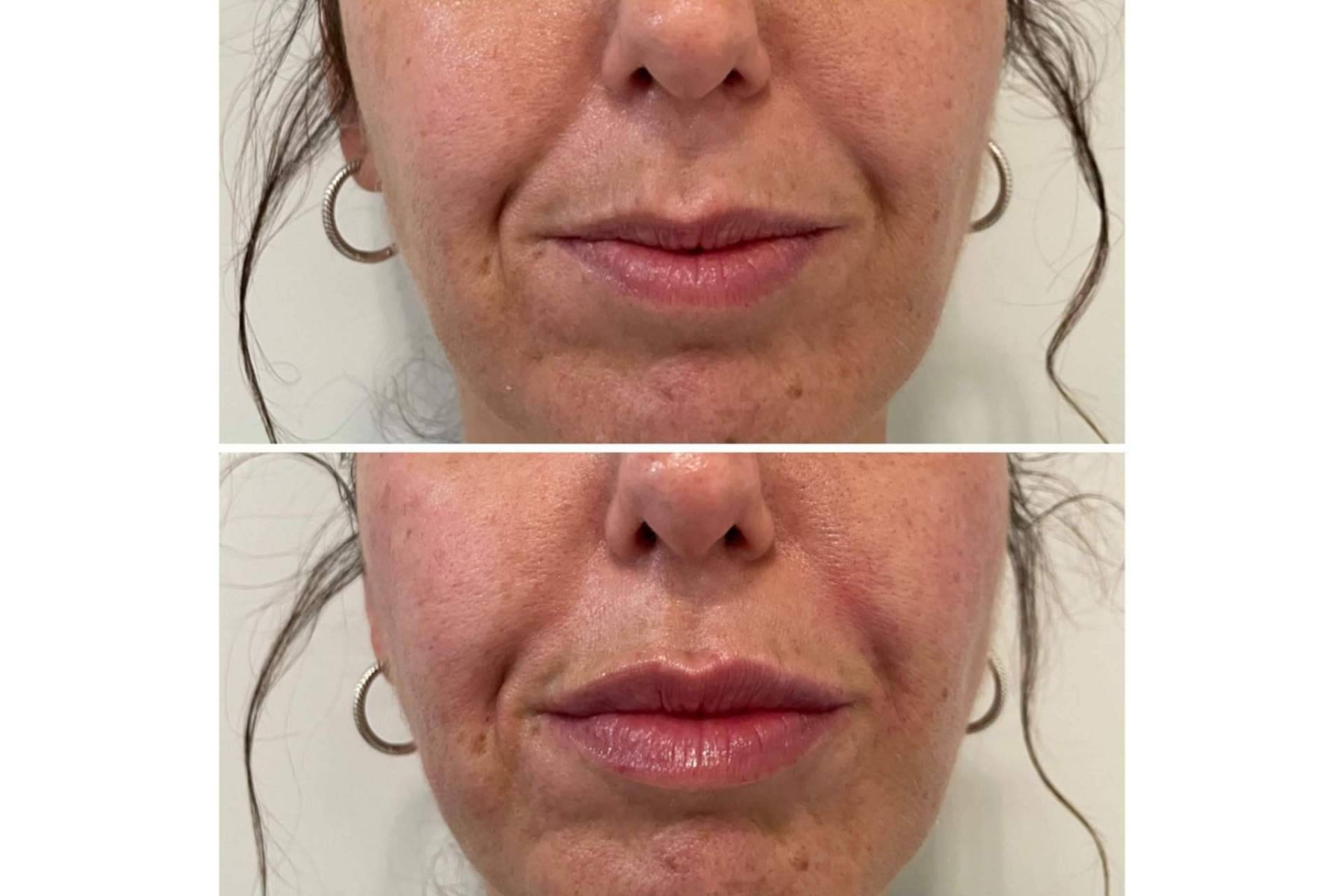 ¿Se puede conseguir un aumento de labios en Madrid con resultados naturales?, por la Dra. Cecilia Arthur