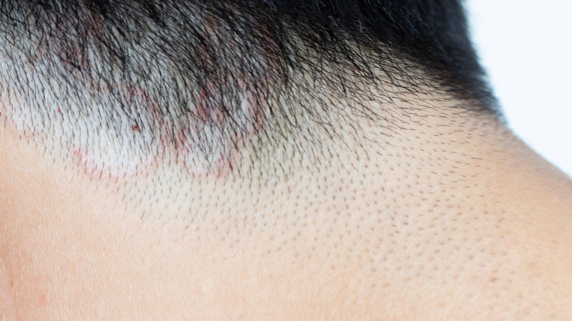 ¿Pueden contagiar los perros la alopecia por tiña del cuero cabelludo?