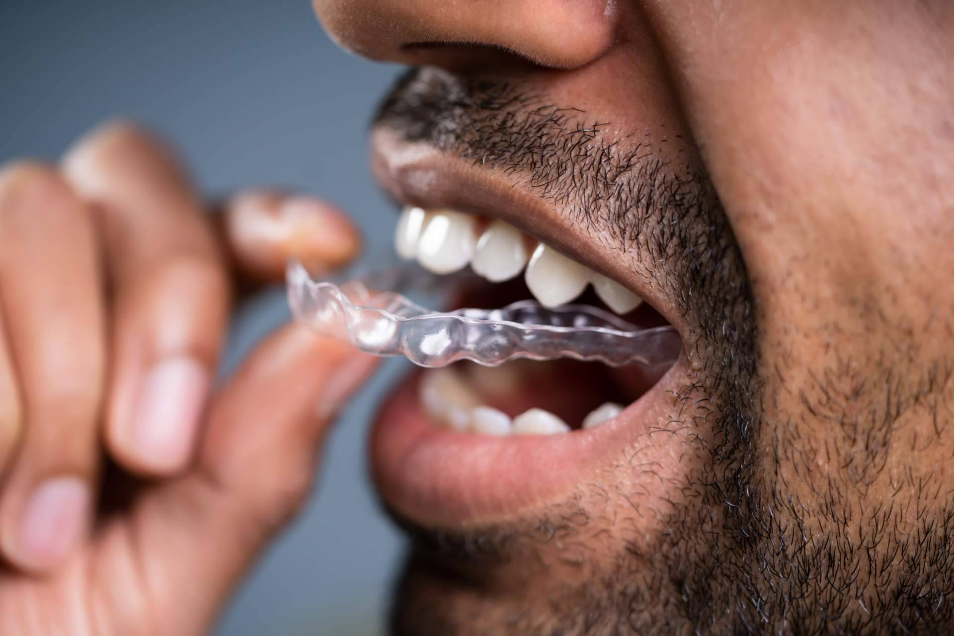 Beneficios de la ortodoncia invisible, por Clínicas Dental Bell