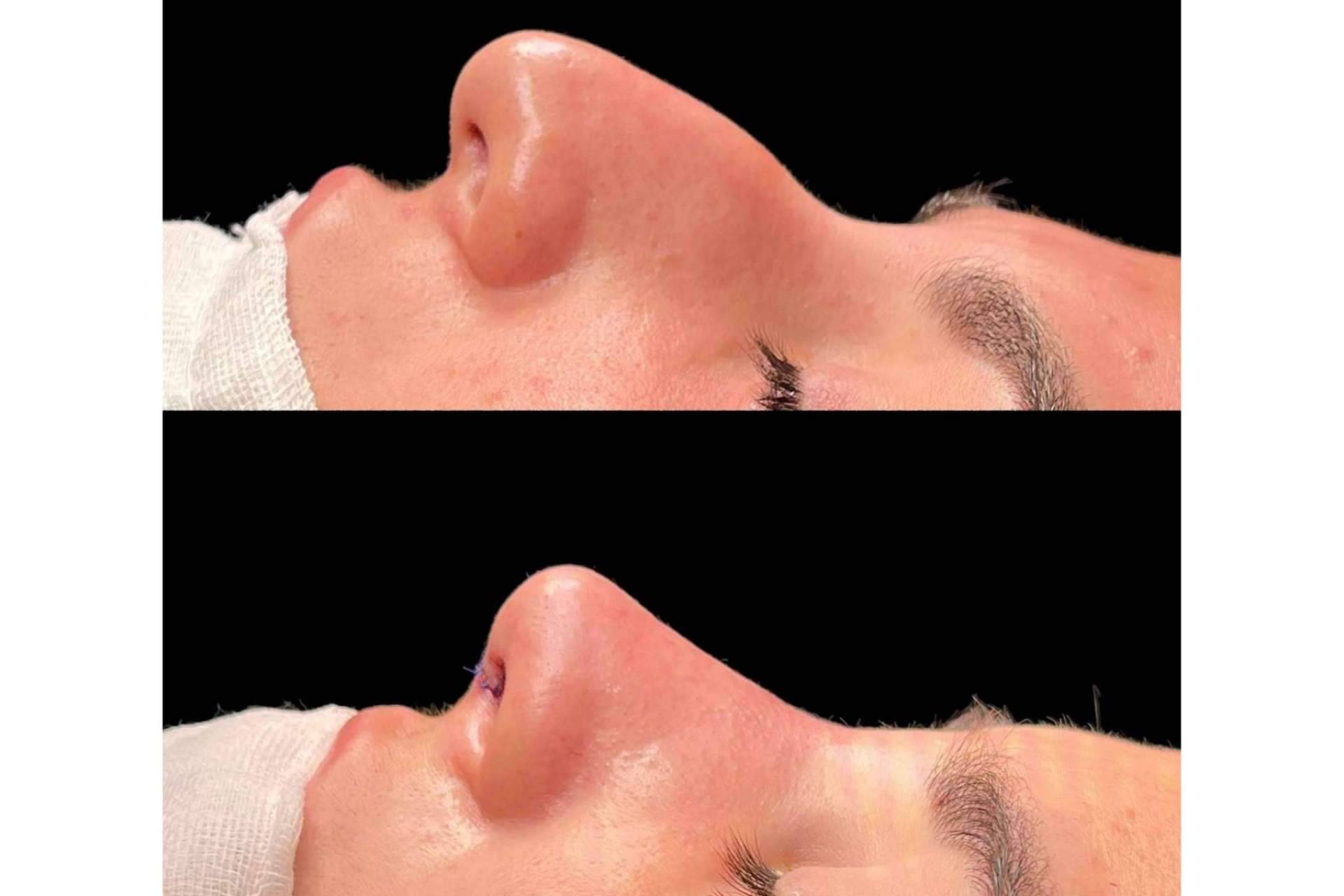 El Dr. Pérez Villar explica cómo recuperarse de una rinoplastia