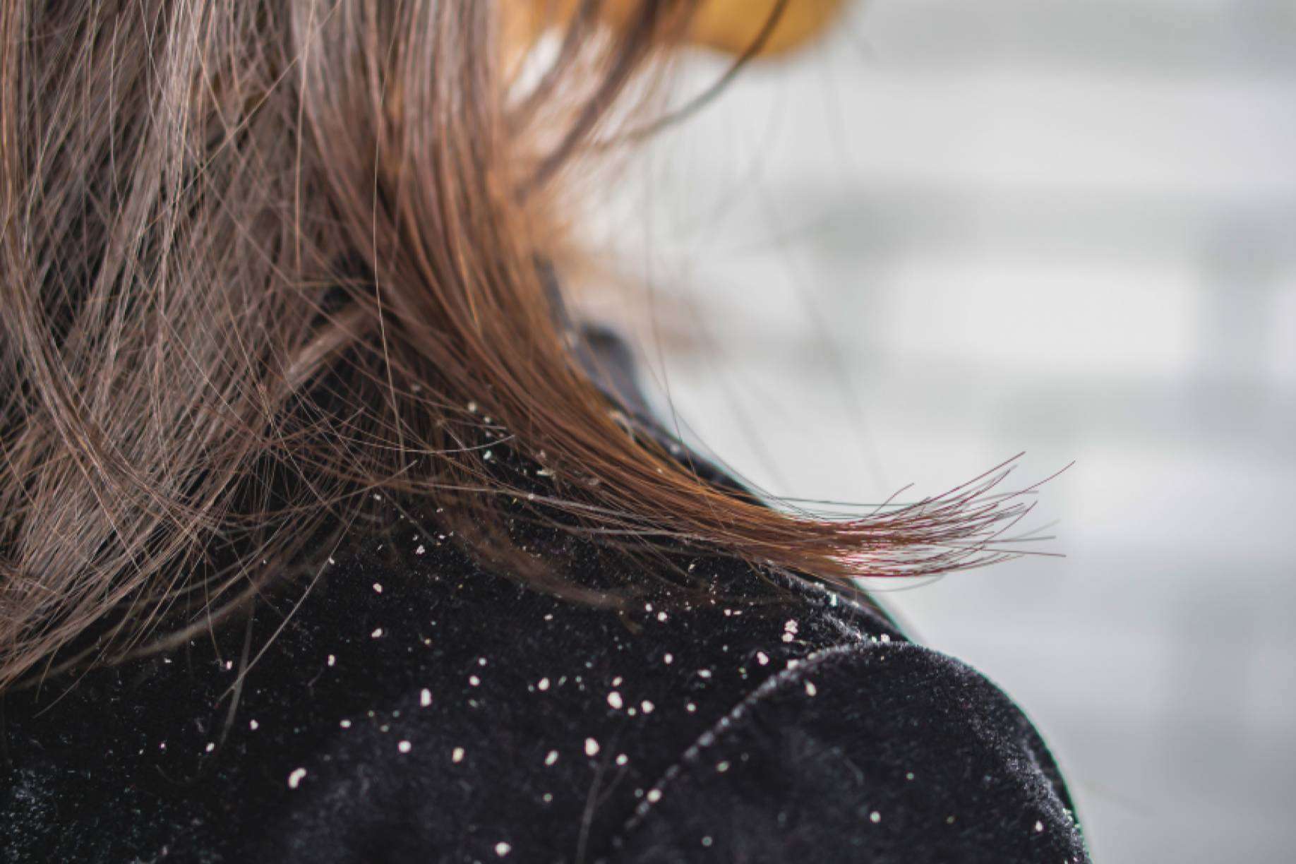 La caspa, ¿culpable de la caída del cabello?