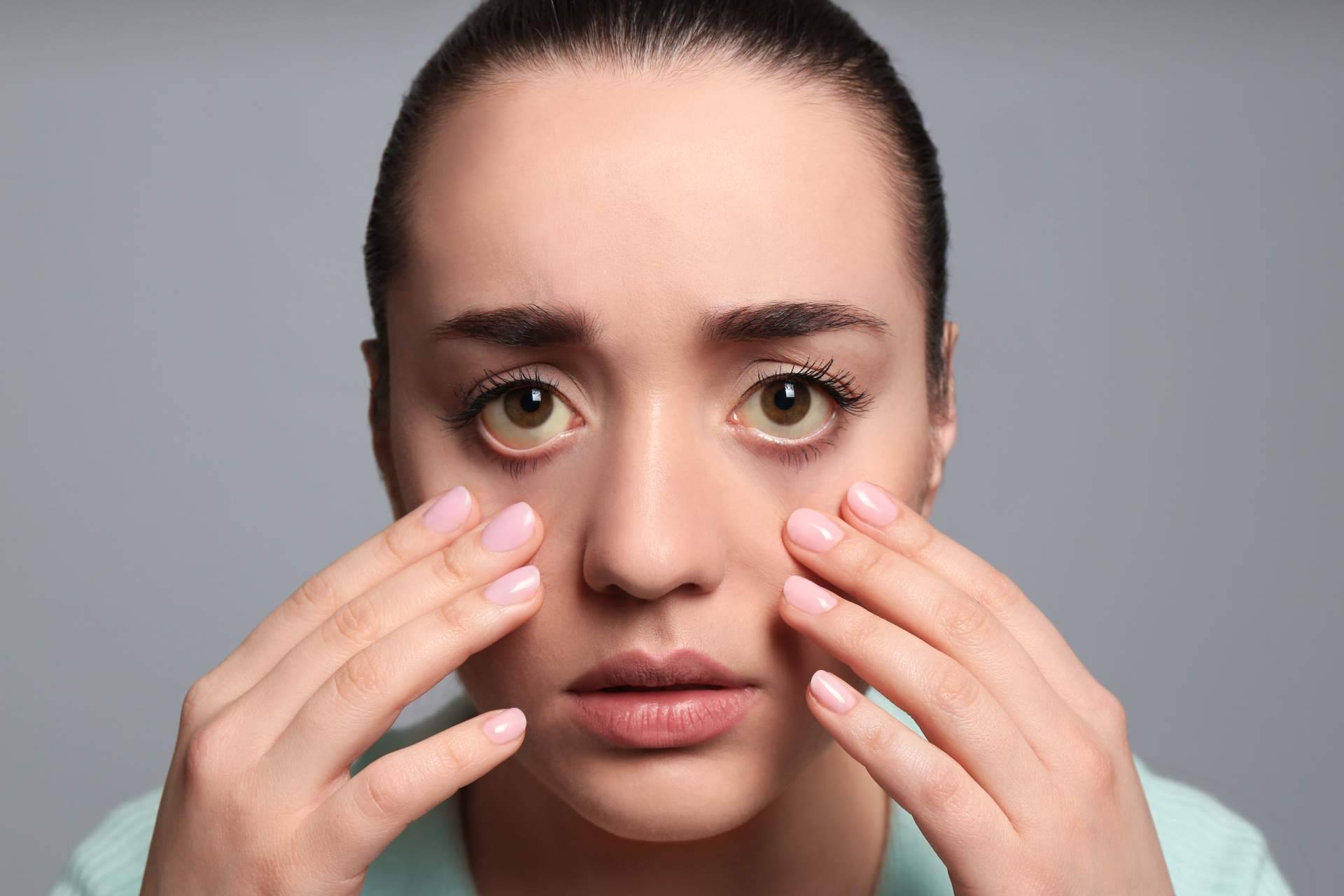 ¿A qué se deben los ojos amarillos y dónde tratarlos?, el Instituto Oftalmológico Dexeus lo explica