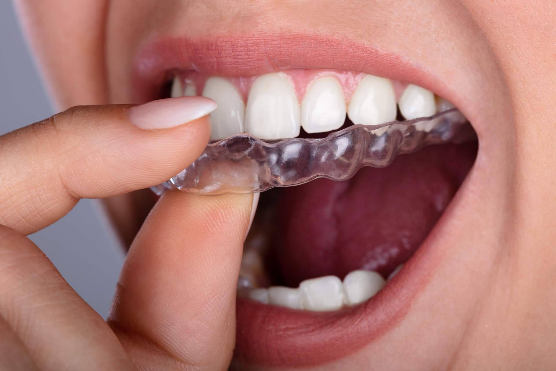 Los implantes y el tratamiento de ortodoncia que aplica DrMouth