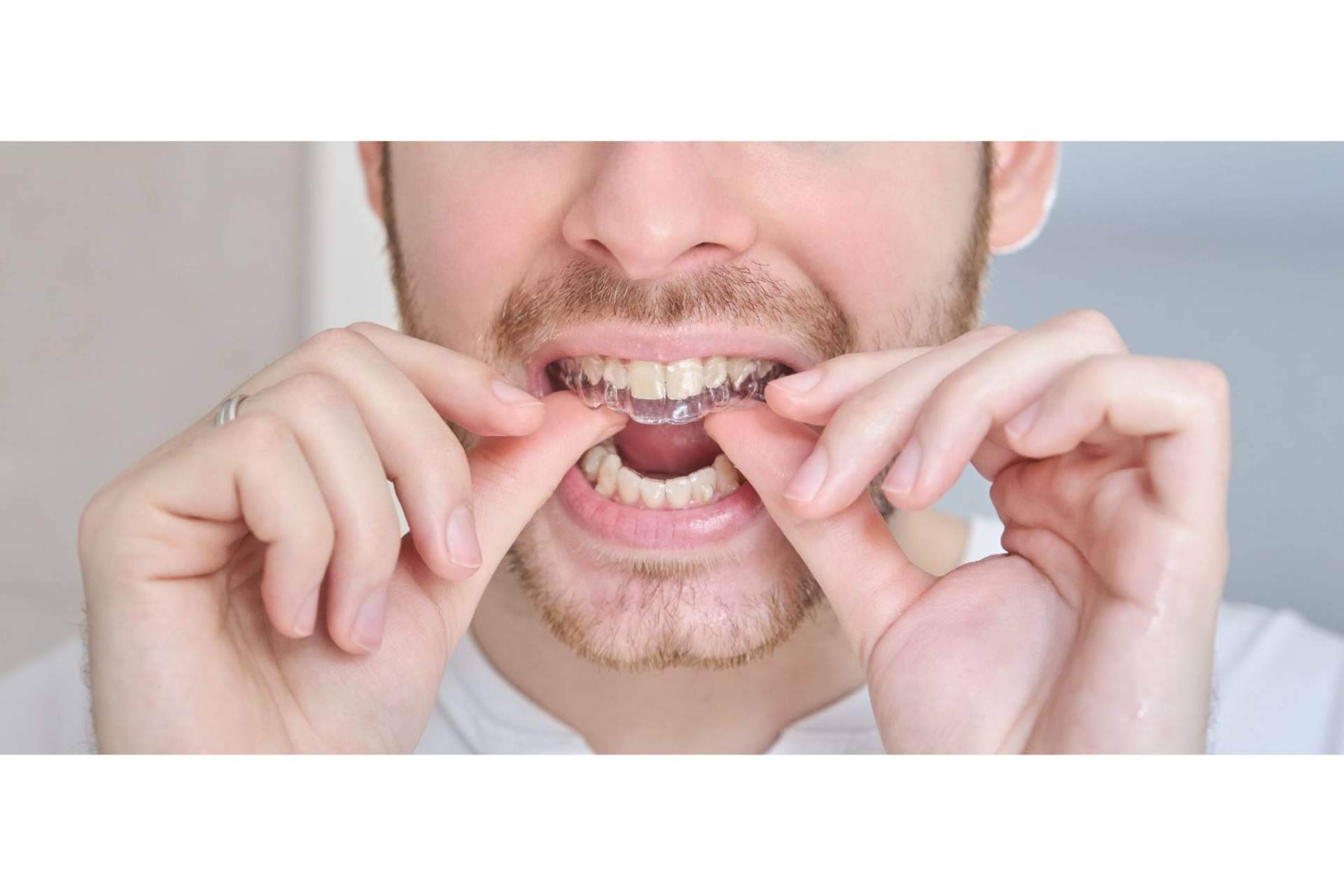 Los beneficios de la ortodoncia invisible, por Clínica Dental Delgado
