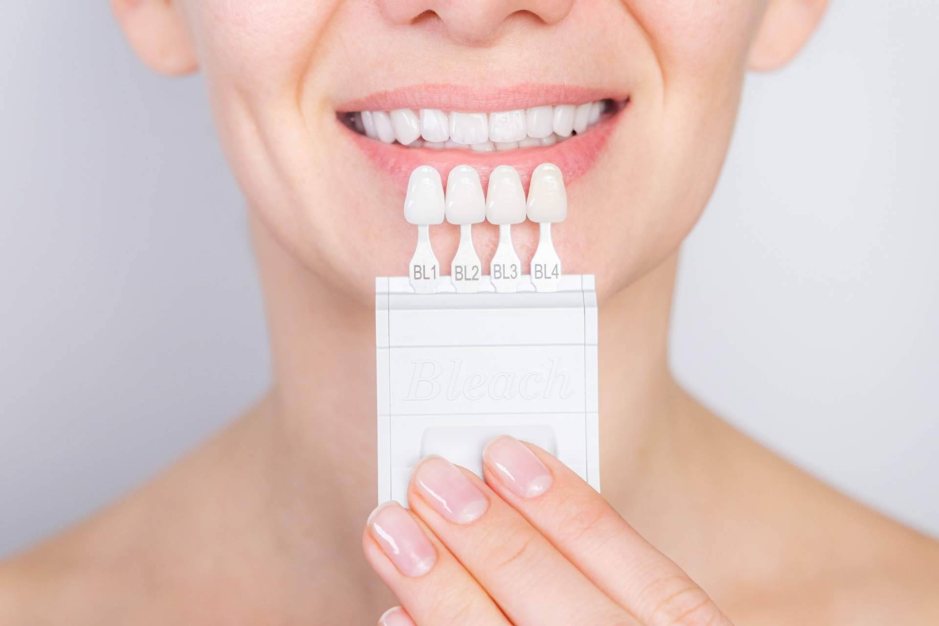 Las carillas dentales en Clínica Dental Delgado para mejorar la sonrisa de sus pacientes