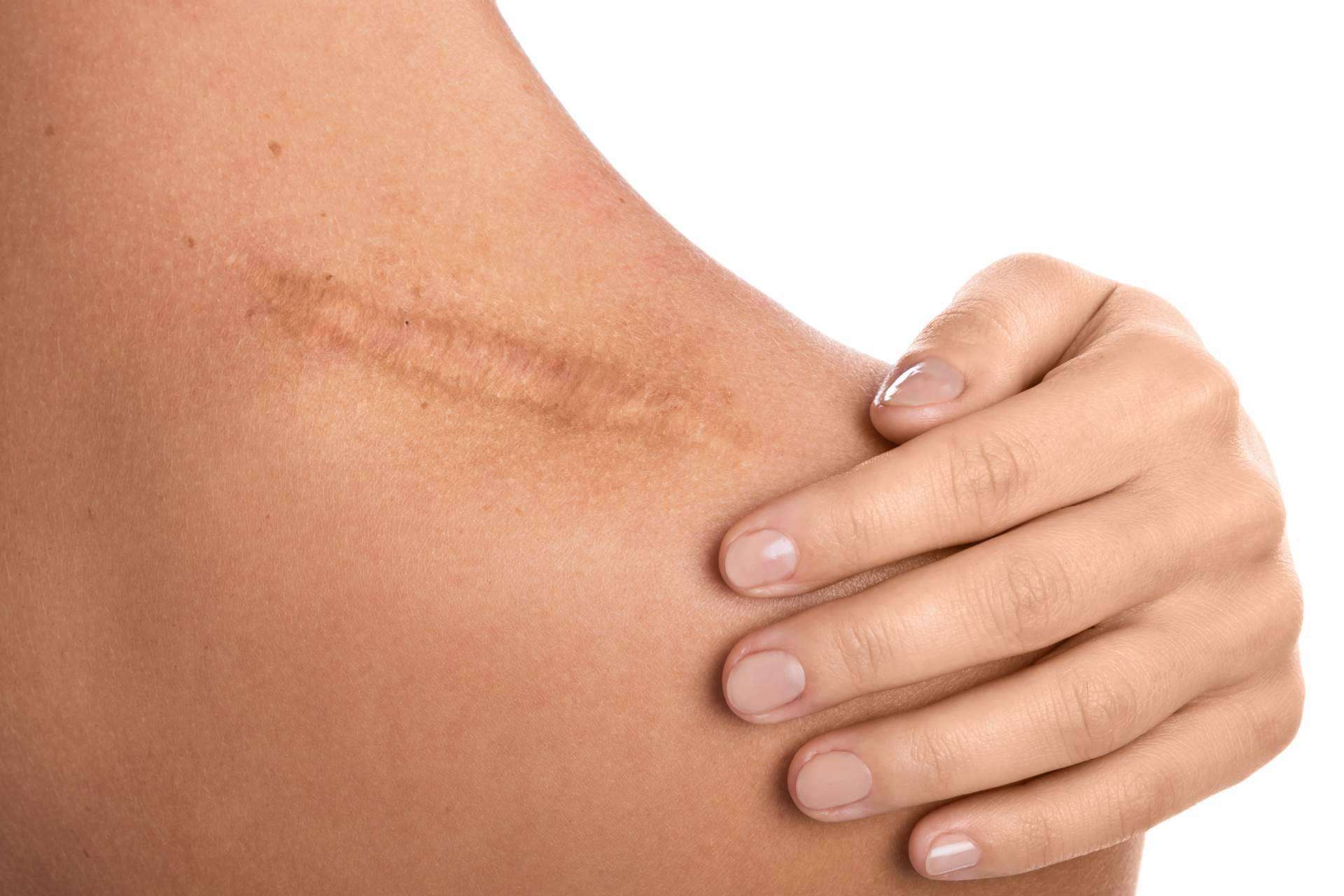 Los expertos de La Parafarmacia del Puerto explican cómo cuidar las cicatrices en la piel de cara al verano