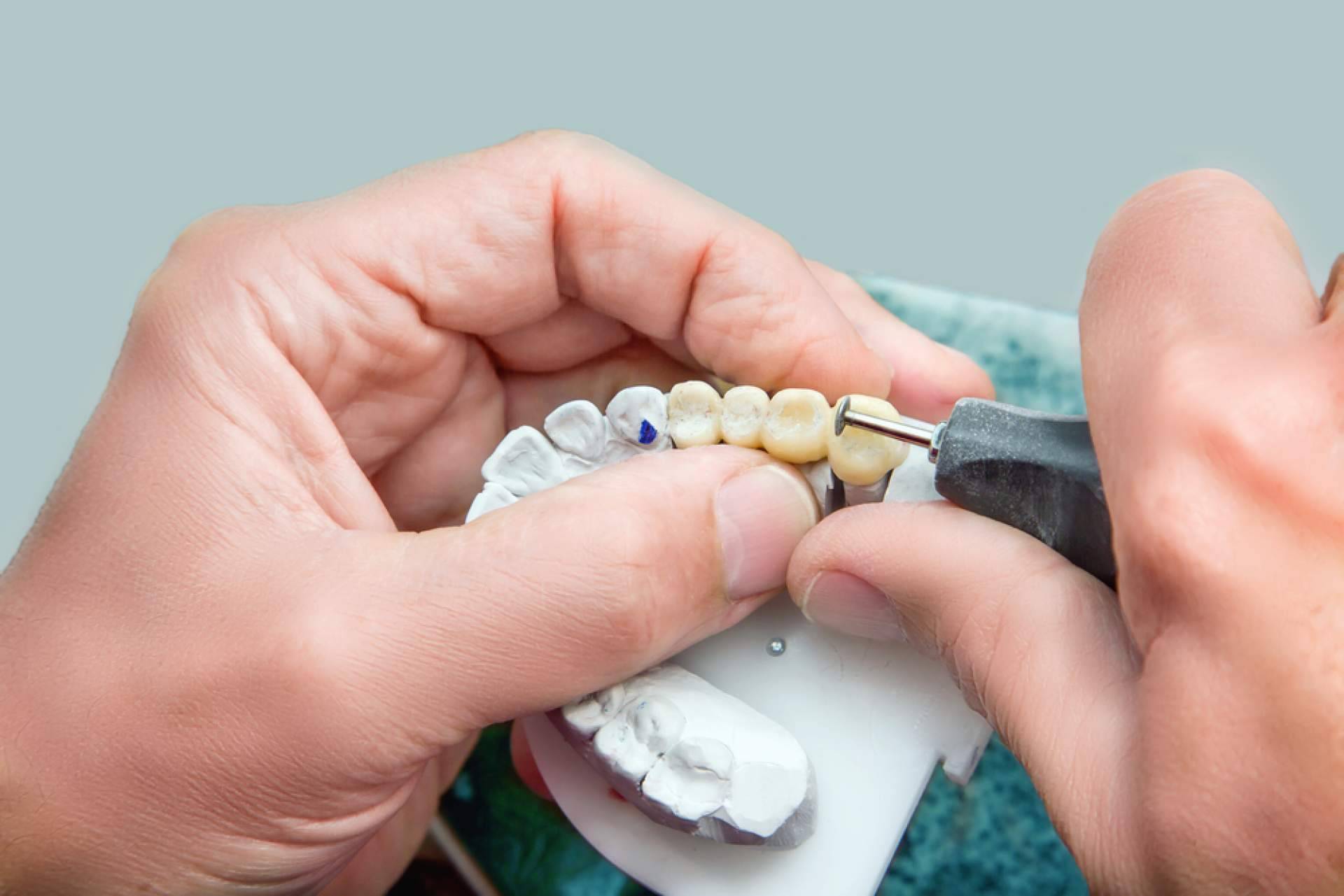 En qué consisten las prótesis sobre implantes, con DrMouth