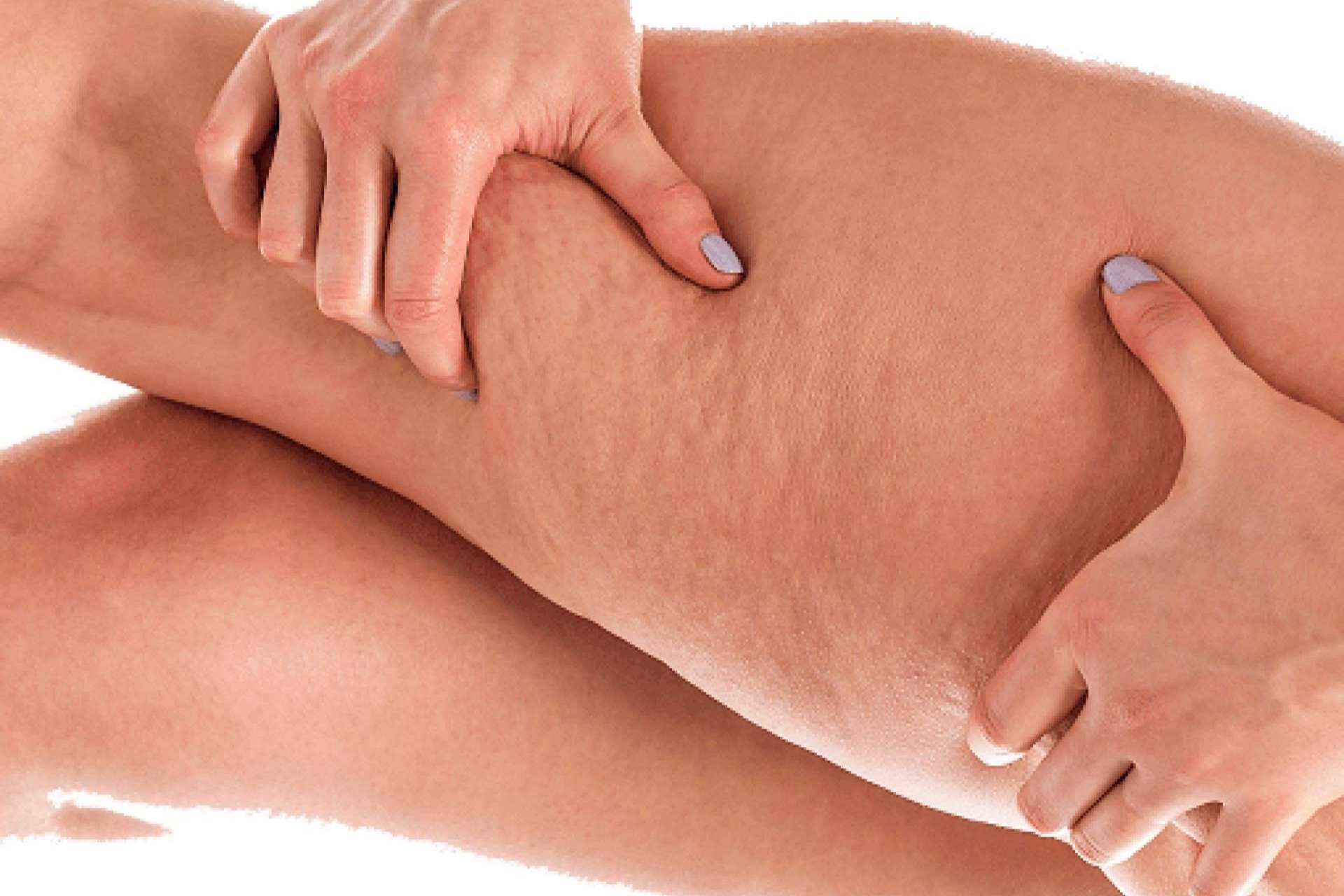Soluciones ofrece sensores especiales para identificar el nivel de la celulitis, a fin de determinar los procesos y terapias acertadas