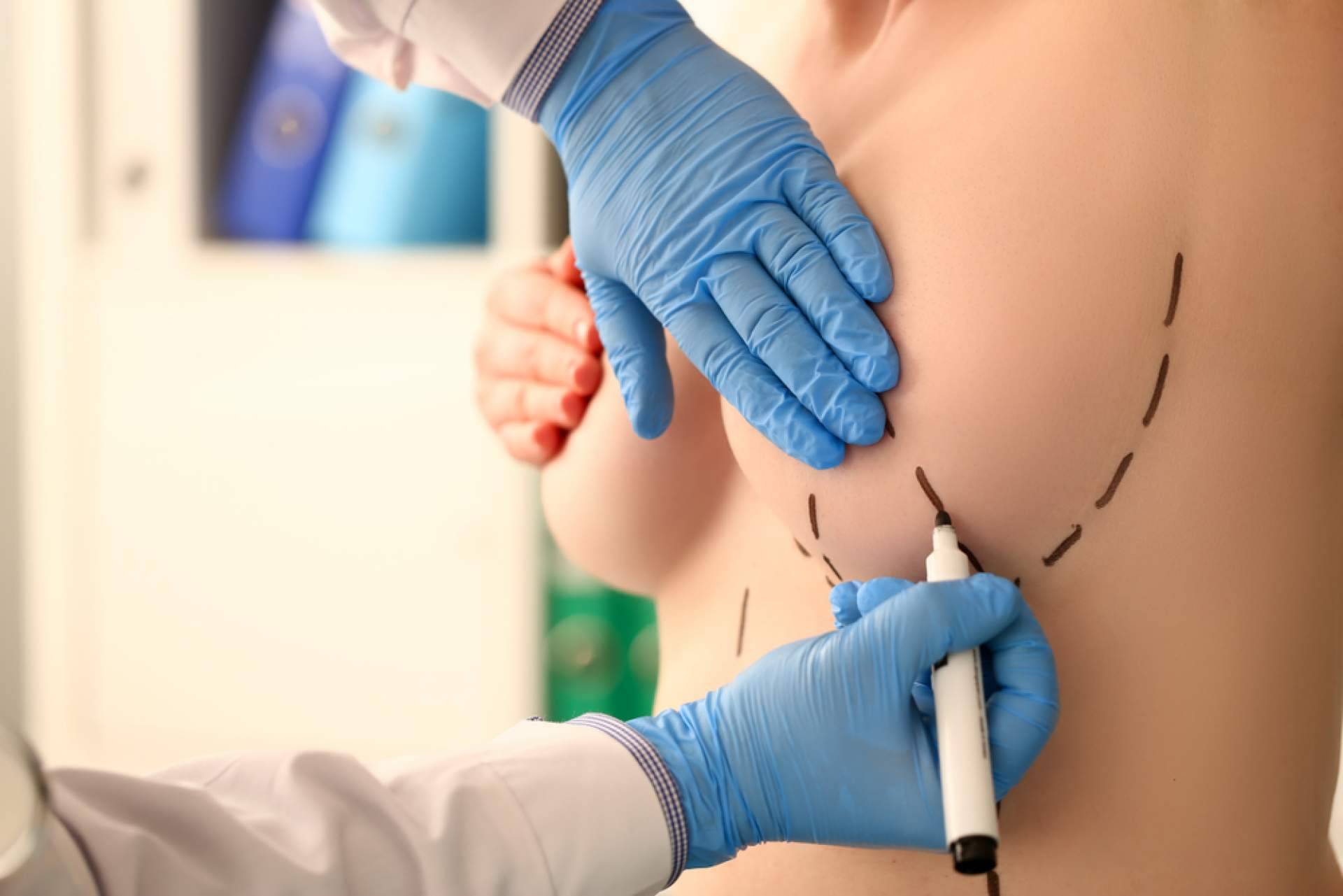 ¿Qué hay que considerar antes de realizarse un aumento de mamas?, con A2Clinic