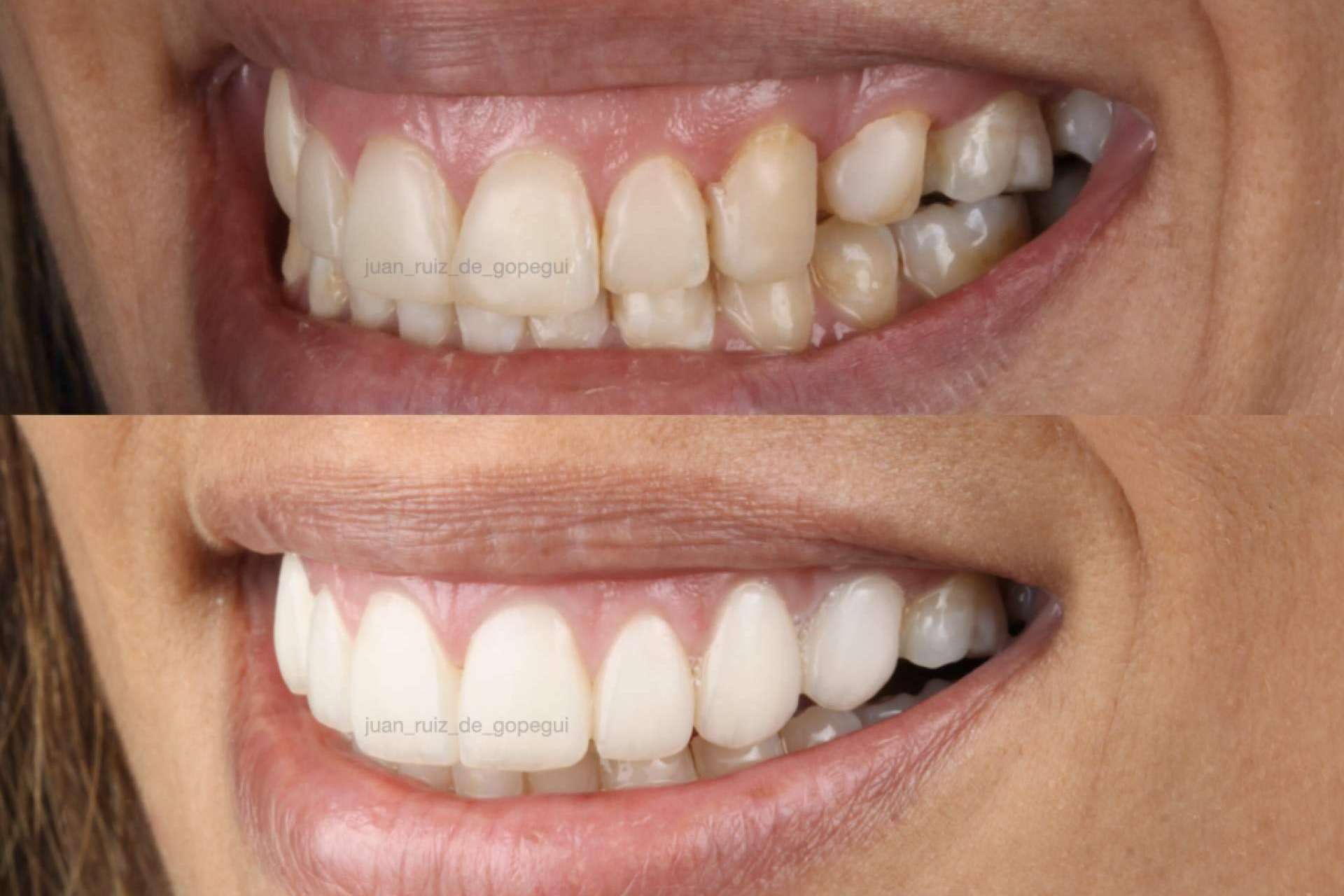 Beneficios de elegir carillas de porcelana para mejorar la sonrisa