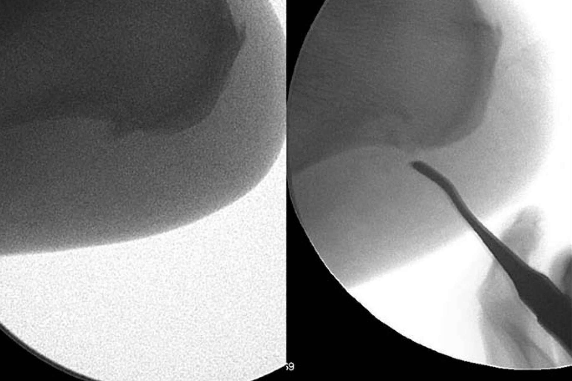 Fascitis plantar y espolón calcáneo, la solución definitiva