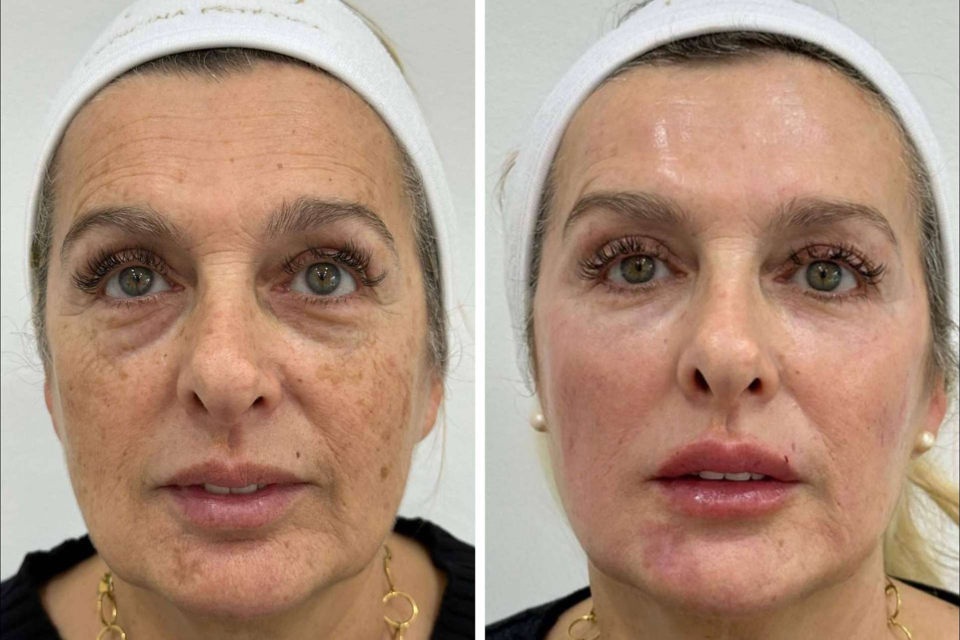 Combatir la flacidez facial, con Clínica VISO