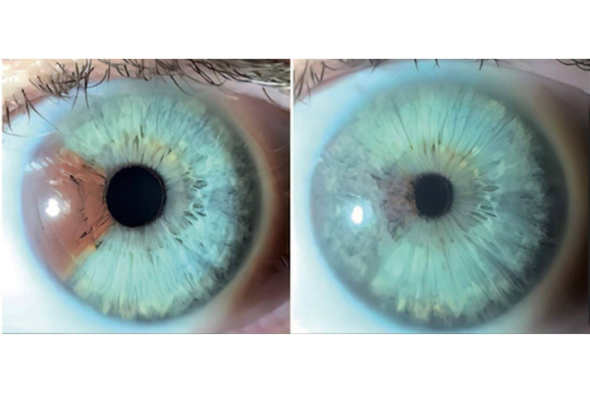 Clínica Eyecos afirma que los heterocromías y los nevus del iris pueden ser tratados con láser