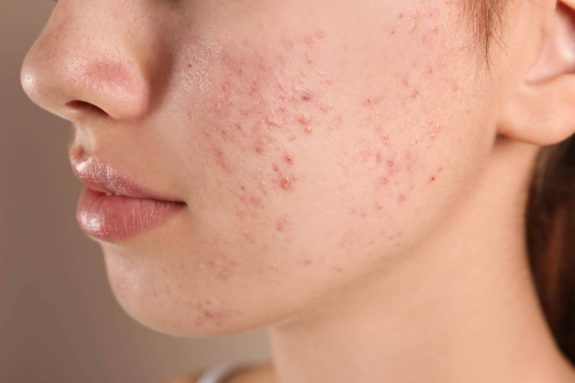Tratamiento de cicatrices de acné con radiofrecuencia fraccionada con microagujas, en Alluring Clinic