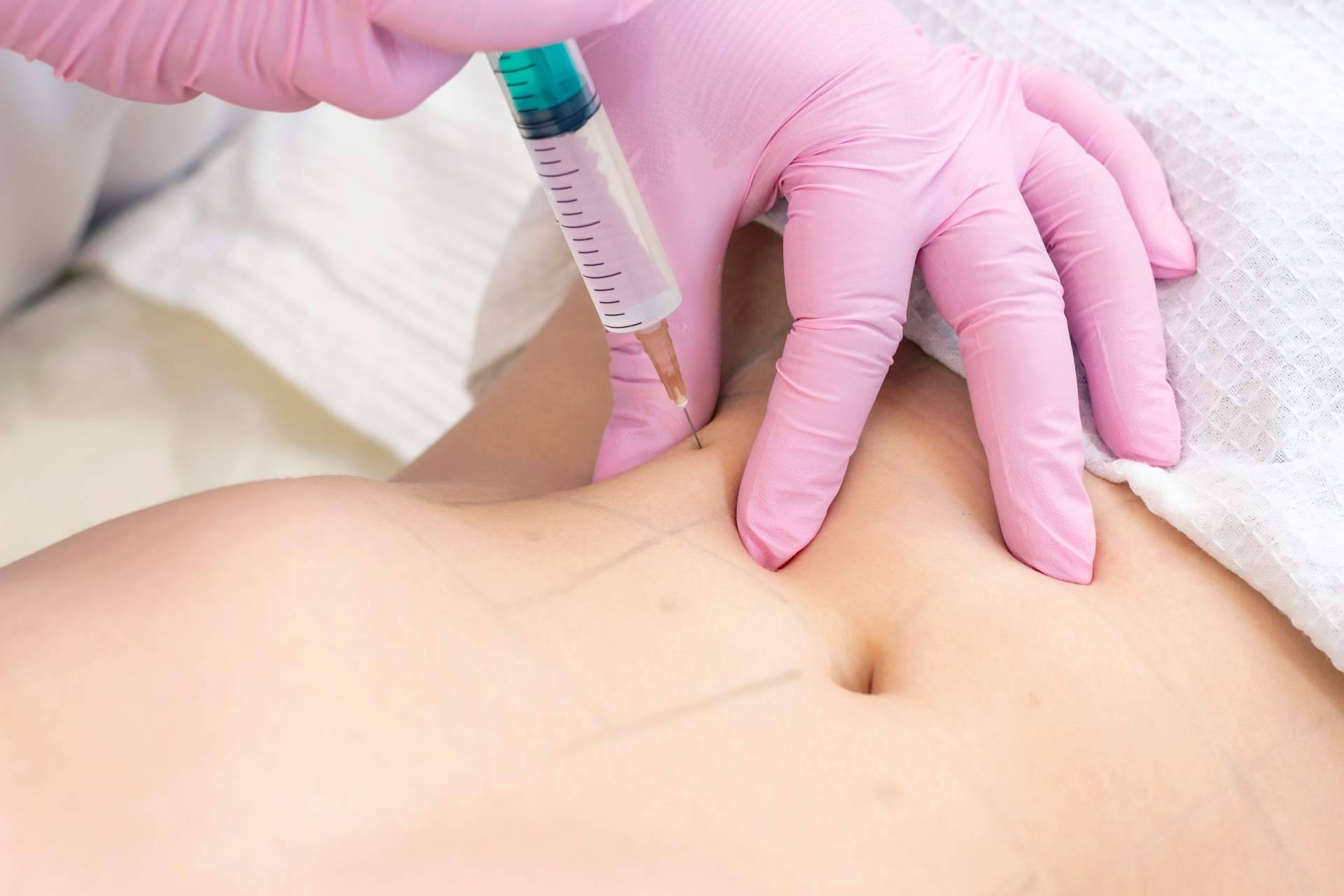 Mesoterapia efectiva contra la celulitis con Alluring Clinic