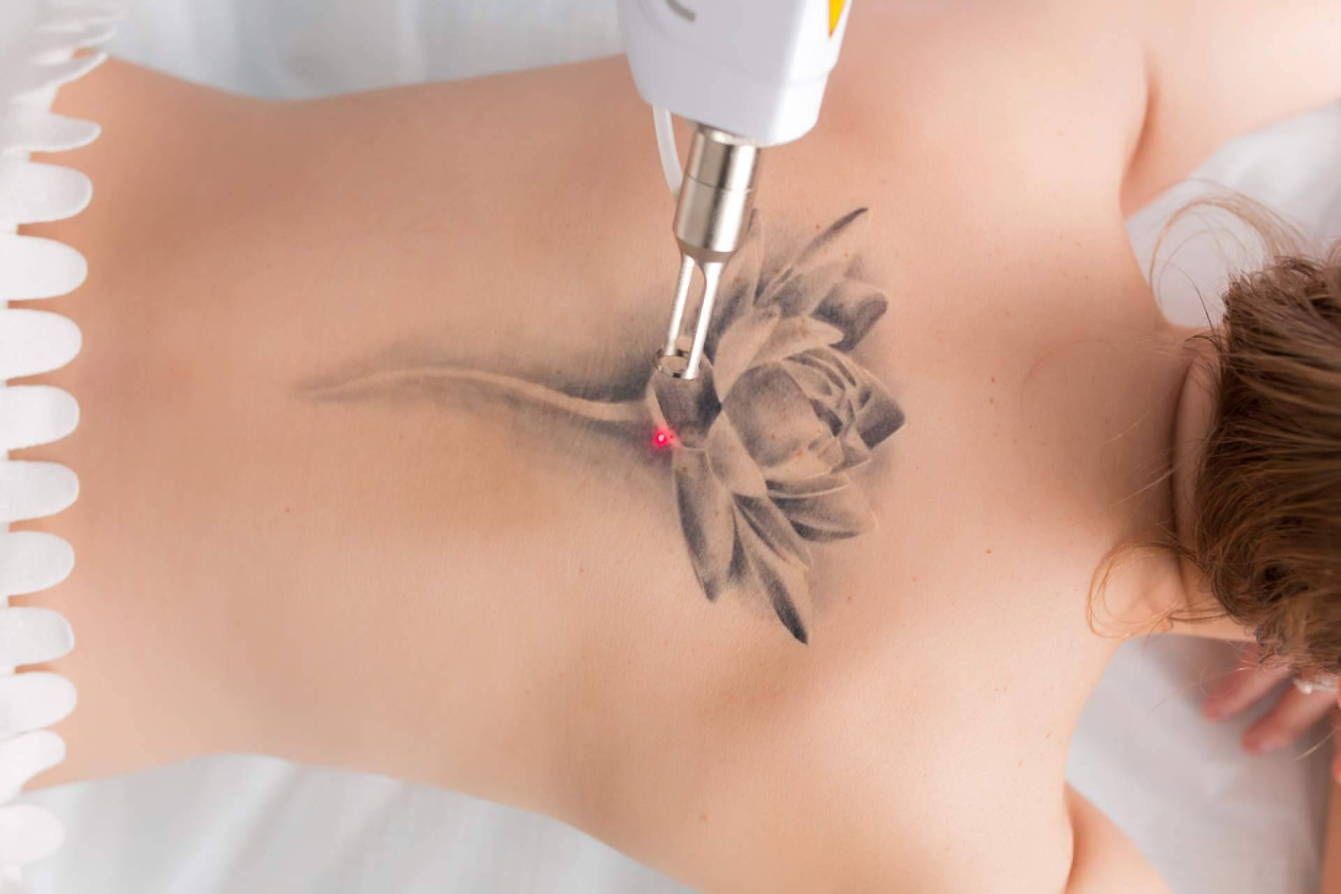 Centro Médico El Pilar, últimas tecnologías para la eliminación de tatuajes