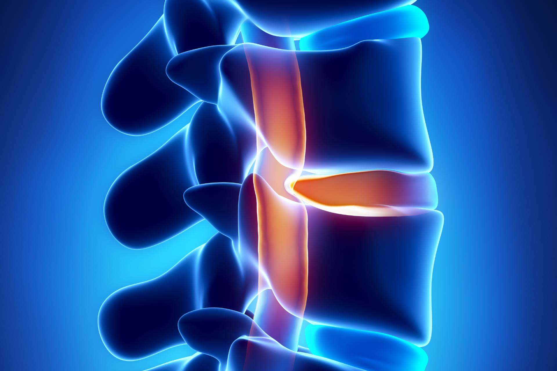 La andulación, un enfoque terapéutico innovador para casos de hernia discal